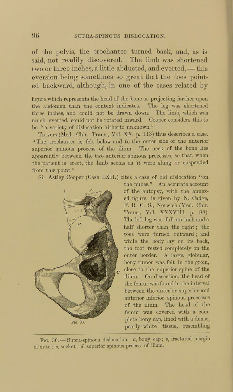 of the pelvis, the trochanter turned back, and, as is said, not readily discovered. The limb was shortened two or three inches, a httle abducted, and everted, — this eversion being sometimes so great that the toes point- ed backward, although, in one of the cases related by figure -which represents the head of the bone as projecting farther upon the abdomen than the context indicates. The leg was shortened three inches, and could not be drawn down. The limb, which was much everted, could not be rotated inward. Cooper considers this to be  a variety of dislocation hitherto unknown. Travers (Med. Chur. Trans., Vol. XX. p. 113) thus describes a case.  The trochanter is felt below and to the outer side of the anterior superior spinous process of the ilium. The neck of the bone lies apparently between the two anterior spinous processes, so that, when the patient is erect, the limb seems as it were slvmg or suspended from this point. Sir Astley Cooper (Case LXII.) cites a case of old dislocation on Fio. 36. — Supra-spinous dislocation, a, bony cap; 6, fractured margin of ditto; c, socket; d, superior spmous process of ilium. Fio. 36. C the pubes. An accurate account of the autopsy, with the annex- ed figure, is given by N. Cadge, F. R. C. S., Norwich (Med. Chu-. Trans., Vol. XXXVIII. p. 88). The left leg was full an inch and a half shorter than the right; the toes were tm-ned outward; and while the body lay on its back, the foot rested completely on the outer border. A large, globidar, bony tiunor was felt in the groin, close to the superior spine of the iliima. On dissection, the head of the femm was found Ln the intex'val between the anterior superior and anterior inferior spinous processes of the ilimn. The head of the femm* was covered with a com- plete bony cap, lined with a dense, pearly-white tissue, resembling