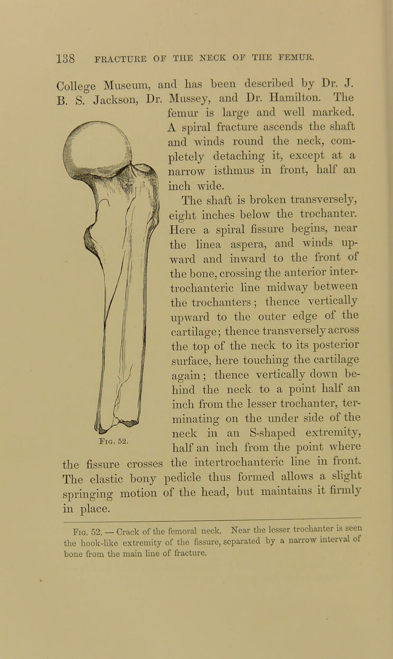 College Museum, and lias been described by Dr. J. B. S. Jackson, Dr. Mussey, and Dr. Hamilton. The femm- is large and well marked. A spiral fracture ascends the shaft and winds round the neck, com- pletely detaching it, except at a narrow isthmus in front, hah' an inch wide. The shaft is broken transversely, eight inches below the trochanter. Here a spiral fissure begins, near the Hnea aspera, and winds up- ward and inward to the front of the bone, crossing the anterior inter- trochanteric line midway between the trochanters ; thence vertically upward to the outer edge of the cartilage; thence transversely across the top of the neck to its posterior surface, here touching the cartilage again; thence vertically down be- hind the neck to a point half an inch from the lesser trochanter, ter- minating on the under side of the neck in an S-shaped extremity, half an inch from the point where the fissure crosses the intertrochanteric line in front. The elastic bony pedicle thus formed allows a slight springing motion of the head, but maintains it firmly in place. Fig. 52. — Crack of the femoral neck. Near the lesser trochanter is seen the hook-like extremity of the fissure, separated by a narrow interval of bone from the main Hne of fracture.