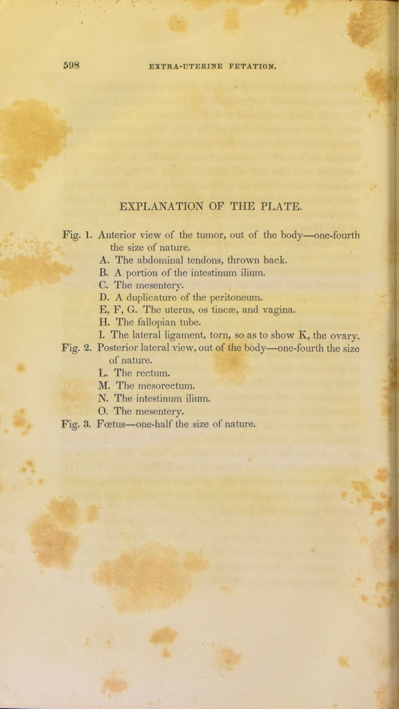 EXPLANATION OF THE PLATE. Fig. 1. Anterior view of the tumor, out of the body—one-fourth the size of nature. A. The abdominal tendons, thrown back. B. A portion of the intestinum ilium. C. The mesentery. D. A duplicature of the peritoneum. E. F, G. The uterus, os tincse, and vagina. H. The fallopian tube. I. The lateral ligament, torn, so as to show K, the ovary. Fig. 2. Posterior lateral view, out of the body—one-fourth the size of nature. L. The rectum. M. The mesorectum. N. The intestinum ilium. O. The mesentery. Fig. 3. Foetus—one-half the size of nature.