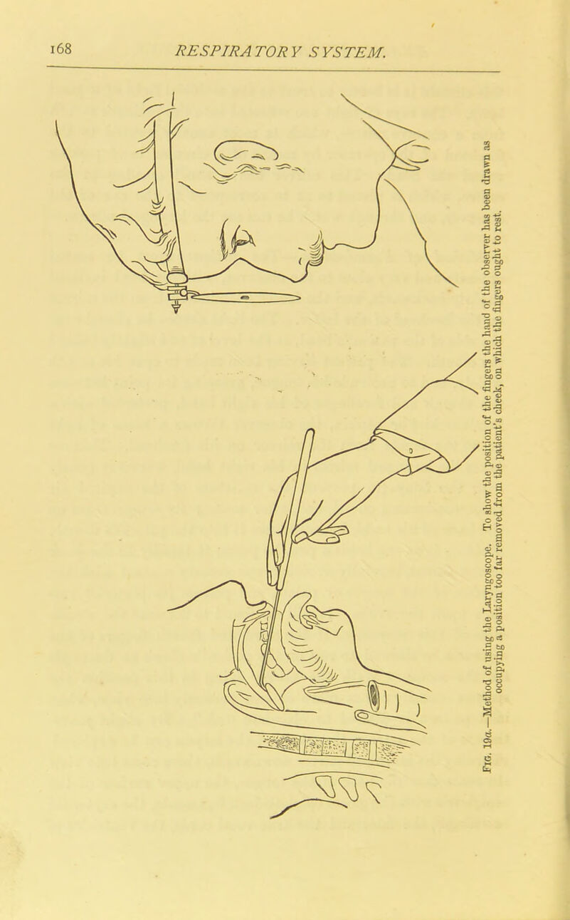 Fig. 19a.—Method of using the Laryngoscope. To show the position of the fingers the hand of the observer has been drawn as occupying a position too far removed from the patient’s cheek, on which the finger's ought to rest.