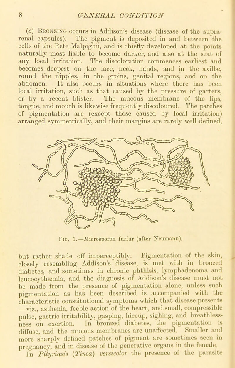 (e) Bronzing occurs in Addison’s disease (disease of the supra- renal capsules). The pigment is deposited in and between the cells of the Rete Malpighii, and is chiefly developed at the points naturally most liable to become darker, and also at the seat of any local irritation. The discoloration commences earliest and becomes deepest on the face, neck, hands, and in the axilla;, round the nipples, in the groins, genital regions, and on the abdomen. It also occurs in situations where there has been local irritation, such as that caused by the pressure of garters, or by a recent blister. The mucous membrane of the lips, tongue, and mouth is likewise frequently discoloured. The patches of pigmentation are (except those caused by local irritation) arranged symmetrically, and their margins are rarely well defined, Fig. 1.—Microsporon furfur (after Neumann). but rather shade off imperceptibly. Pigmentation of the skin, closely resembling Addison’s disease, is met with in bronzed diabetes, and sometimes in chronic phthisis, lymphadenoma and leucocythaemia, and the diagnosis of Addison’s disease must not be made from the presence of pigmentation alone, unless such pigmentation as has been described is accompanied with the characteristic constitutional symptoms which that disease presents —viz., asthenia, feeble action of the heart, and small, compressible pulse, gastric irritability, gasping, hiccup, sighing, and breathless- ness on exertion. In bronzed diabetes, the pigmentation is diffuse, and the mucous membranes are unaffected. Smaller and more sharply defined patches of pigment are sometimes seen in pregnancy, and in disease of the generative organs in the female. In Pityriasis {Tinea) versicolor the presence of the parasite
