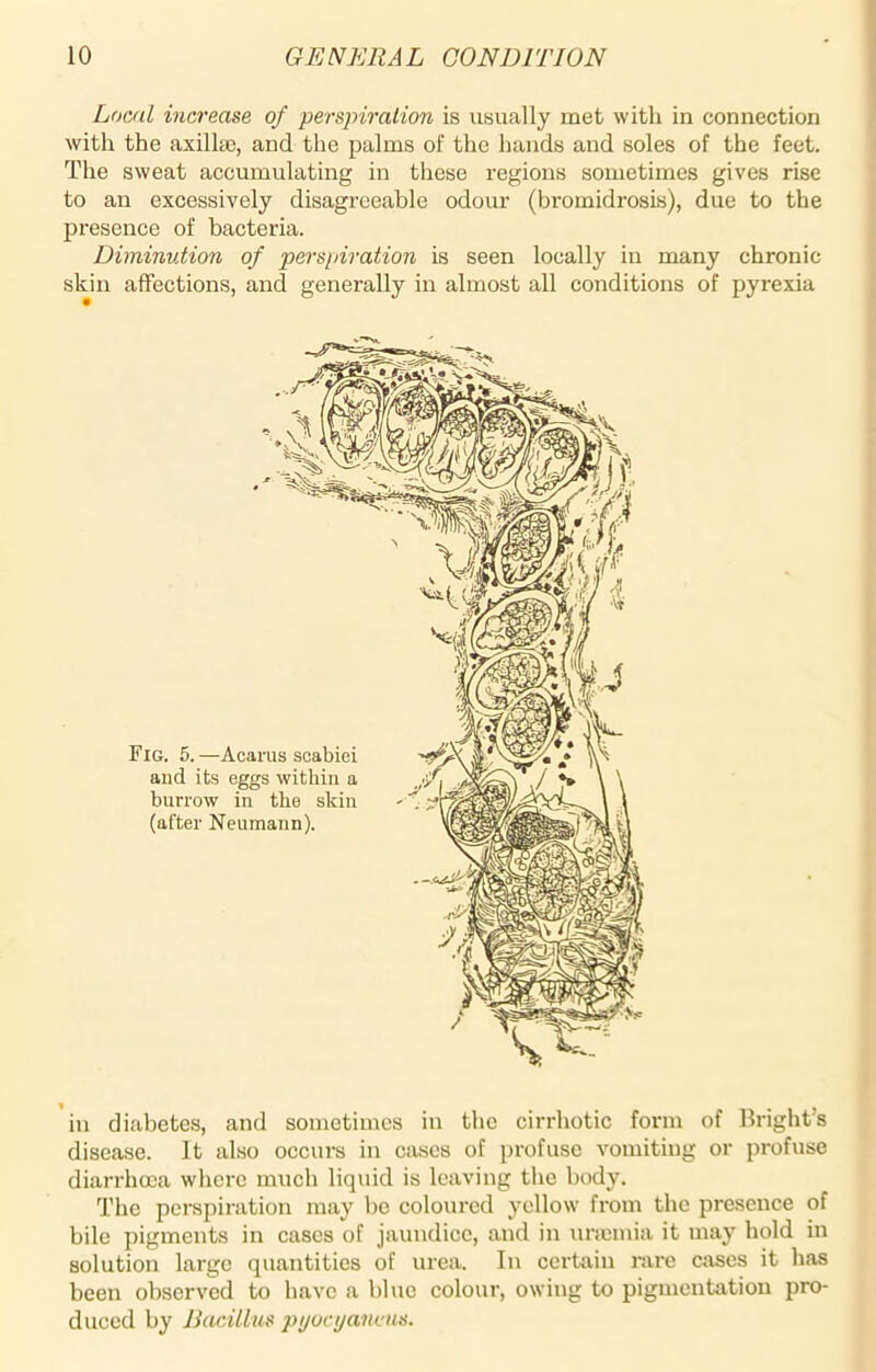 Load increase of perspiration is usually met with in connection with the axillse, and the palms of the hands and soles of the feet. The sweat accumulating in these regions sometimes gives rise to an excessively disagreeable odour (bromidrosis), due to the presence of bacteria. Diminution of perspiration is seen locally in many chronic skin affections, and generally in almost all conditions of pyrexia Fig. 5. —Acarus scabiei and its eggs within a burrow in the skin (after Neumann). in diabetes, and sometimes in the cirrhotic form of Brights disease. It also occurs in cases of profuse vomiting or profuse diarrhoea where much liquid is leaving the body. The perspiration may be coloured yellow from the presence of bile pigments in cases of jaundice, and in uraemia it may hold in solution large quantities of urea. In certain rare cases it has been observed to have a blue colour, owing to pigmentation pro- duced by Bacillus pyocyaimis.