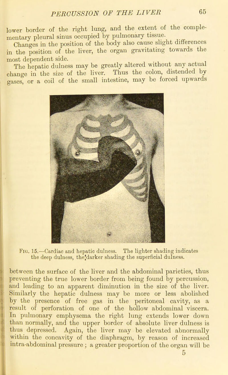 lower border of the right lung, and the extent of the comple- mentary pleural sinus occupied by pulmonary tissue. Changes in the position of the body also cause slight differences in the position of the liver, the organ gravitating towards the most dependent side. The hepatic dulness may be greatly altered without any actual change in the size of the liver. Thus the colon, distended by gases, or a coil of the small intestine, may be forced upwards Fig. 15.—Cardiac and hepatic dulness. The lighter shading indicates the deep dulness, thejdarker shading the superficial dulness. between the surface of the liver and the abdominal parieties, thus preventing the true lower border from being found by percussion, and leading to an apparent diminution in the size of the liver. Similarly the hepatic dulness may be more or less abolished by the presence of free gas in the peritoneal cavity, as a result of perforation of one of the hollow abdominal viscera. In pulmonary emphysema the right lung extends lower down than normally, and the upper border of absolute liver dulness is thus depressed. Again, the liver may be elevated abnormally within the concavity of the diaphragm, by reason of increased intra-abdominal pressure ; a greater proportion of the organ will be 5