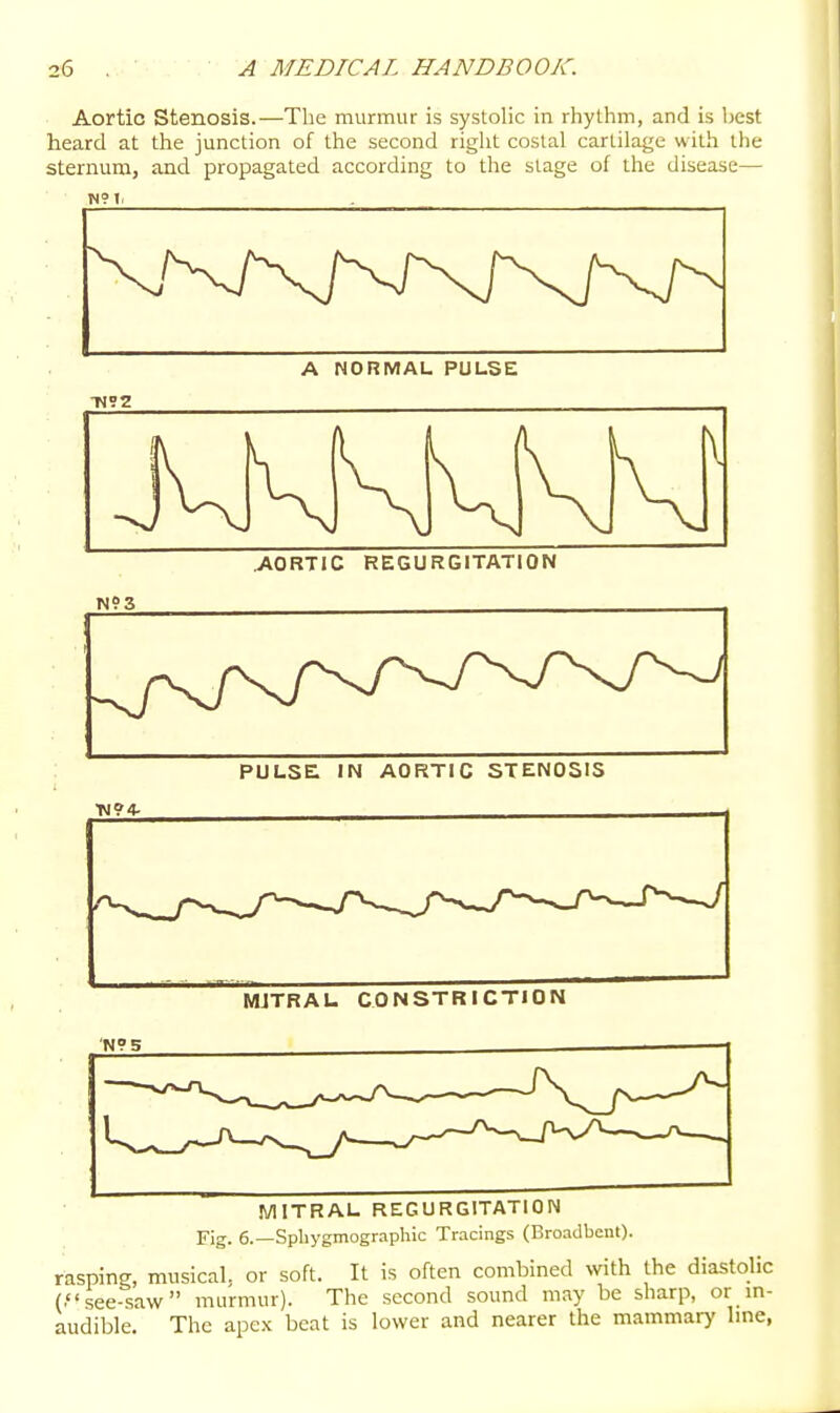 Aortic Stenosis.—The murmur is systolic in rhythm, and is best heard at the junction of the second right costal cartilage with the sternum, and propagated according to the stage of the disease— Tl?1. . A NORMAL PULSE M \ AORTIC REGURGITATION PULSE ■N94- IN AORTIC STENOSIS MJTRAU CONSTRICTION 'N°5 MITRAL REGURGITATION Fig. 6.—Spliygmographic Tracings (Broadbent). rasping, musical, or soft. It is often combined with the diastolic (.see-saw murmur). The second sound may be sharp, or in- audible. The apex beat is lower and nearer the mammary Ime,