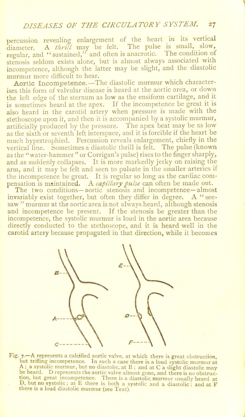 percussion revealing enlargement of the heart in its vertical diameter. A i/u-ill may be felt. The pulse is small, slow, regular, and sustained, and often is anacrotic. The condition of stenosis seldom exists alone, but is almost always associated with incompetence, although the latter may be slight, and the diastolic murmur more difficult to hear. Aortic Incompetence.—The diastolic murmur which character- ises this form of valvular disease is heard at the aortic area, or down the left edge of the sternum as low as the ensiform cartilage, and it is sometimes heard at the apex. If the incompetence be great it is also heard in the carotid artery when pressure is made with the stethoscope upon it, and then it is accompanied by a systoHc murmur, artificially produced by the pressure. The apex beat may be as low as the sixth or seventh left interspace, and it is forcible if the heart be much hypertrophied. Percussion reveals enlargement, chiefly in the vertical line. Sometimes a diastolic thrill is felt. The pulse (known as the water-hammer or Corrigan's pulse) rises to the finger sharply, and as suddenly collapses. It is more markedly jerky on raising the arm, and it may be felt and seen to pulsate in the smaller arteries if the incompetence be great. It is regular so long as the cardiac com- pensation is maintained. A capillary f alse can often be made out. The two conditions—aortic stenosis and incompetence—almost invariably exist together, but often they differ in degree. A  see- saw  murmur at the aortic area is not always heard, although stenosis and incompetence be present. If the stenosis be greater than the incompetence, the systolic murmur is loud in the aortic area because directly conducted to the stethoscope, and it is heard well in the carotid artery because propagated in that direction, while it becomes Fig. 7.—A represents .1 caldfied aortic valve, at which there is great obstruction, but trifling incompetence. In such a case there is a loud systolic murmur at A ; a systolic murmur, but no diastolic, at B : and at C a slight diastolic may be heard. D represents the aortic valve almost gone, and there is no obstruc- tion, but great incompetence. There is a diastolic murmur usually heard at D, but no systolic; at E there is both a systolic and a diastolic ; and at F there is a loud diastolic murmur (see Text).