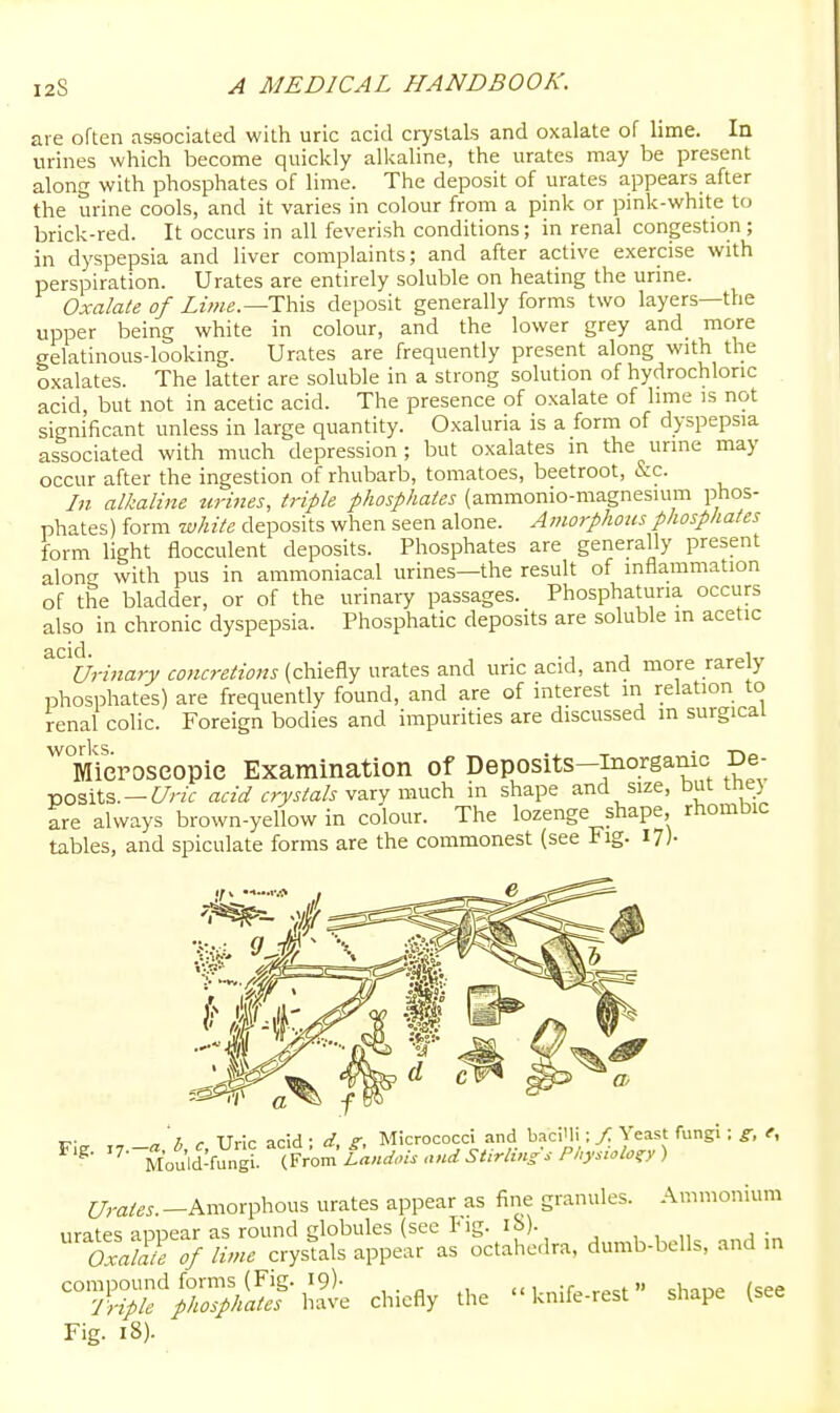 are often associated with uric acid crystals and oxalate of lime. la urines which become quickly alkaline, the urates may be present along with phosphates of lime. The deposit of urates appears after the urine cools, and it varies in colour from a pink or pink-white to brick-red. It occurs in all feverish conditions; in renal congestion; in dyspepsia and liver complaints; and after active exercise with perspiration. Urates are entirely soluble on heating the urine. Oxalate of Zzw«.—This deposit generally forms two layers—the upper being white in colour, and the lower grey and more aelatinous-looking. Urates are frequently present along with the oxalates. The latter are soluble in a strong solution of hydrochloric acid, but not in acetic acid. The presence of oxalate of lime is not significant unless in large quantity. Oxaluria is a form of dyspepsia associated with much depression; but oxalates m the urine may occur after the ingestion of rhubarb, tomatoes, beetroot, &c. In alkaline tirines, triple phosphates (ammonio-magnesium phos- phates) form white deposits when seen alone. Amorfhotis phosphates form light flocculent deposits. Phosphates are generally present along with pus in ammoniacal urines—the result of inflammation of the bladder, or of the urinary passages. Phosphatuna occurs also in chronic dyspepsia. Phosphatic deposits are soluble m acetic ^^^%-inary concretions (chiefly urates and uric acid, and more rarely phosiDhates) are frequently found, and are of interest in relation to renal colic. Foreign bodies and impurities are discussed in surgical Mieroseopie Examination of Deposits-inorgamo De- iDOSits. —t/r/f acid crystals viccy m\\z\i in shape and size, but tney are always brown-yellow in colour. The lozenge shape, rhombic tables, and spiculate forms are the commonest (see Fig. i?)- ir-„ n h r Uric acid : d, g, Micrococci and baci'li: / Yeast fungi : g, e, '-Mould-fungi. (From'/Aw.n- and Stirtin/s Physiolo^ ) t/m/...-Amorphous urates appear as fine granules. Ammonium urates appear as round globules (sec iMg. lb). , , :„ OxaMe of lime crystals appear as octahedra, dumb-bells, and m compound forms (Fig. 19)- << i „;r<> r^^t  shane (see Triple phosphates have chiefly the knife-rest shape (see Fig. 18).