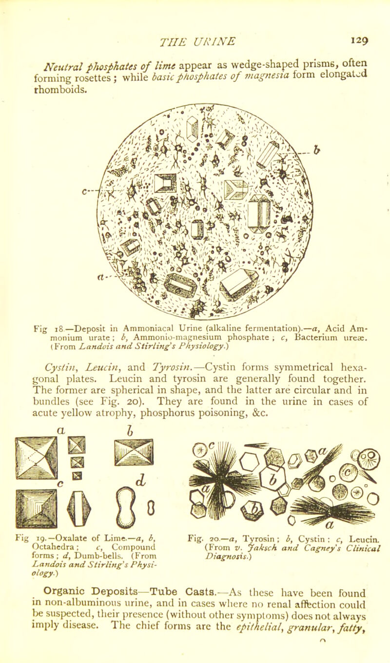 Neutral phosphates of lime appear as wedge-shaped prisms, often forming rosettes ; while basic phosphates of magnesia form elongated rhomboids. F!g 18—Deposit in Ammoniacal Urine (alkaline fermentation).—a. Acid Am- monium urate; Ammonio-magnesium phosphate ; c, Bacterium urese. (From Landois and Stirling's Physiology.) CyStill, Leucin, and Tyrosin.—Cystin forms symmetrical hexa- gonal plates. Leucin and tyrosin are generally found together. The former are spherical in shape, and the latter are circular and in bundles (see Fig. 20). They are found in the urine in cases of acute yellow atrophy, phosphorus poisoning, &c. a I ig ig.—Oxalate of Lime.—<j, b. Fig. 10—a, Tyrosin; b, Cystin; c, Leucin. Octahedra; c. Compound (From v. Jaksch and Cagney's Clinical forms; Dumb-bells. (From Diagnosis,) Landois and Stirling's Physi- ology.) Organic Deposits—Tube Casta.--As these have been found in non-albuminous urine, and in cases where no renal affection could be suspected, their presence (without other symptoms) does not always imply disease. The chief forms are the epithelial, granular, fatty.