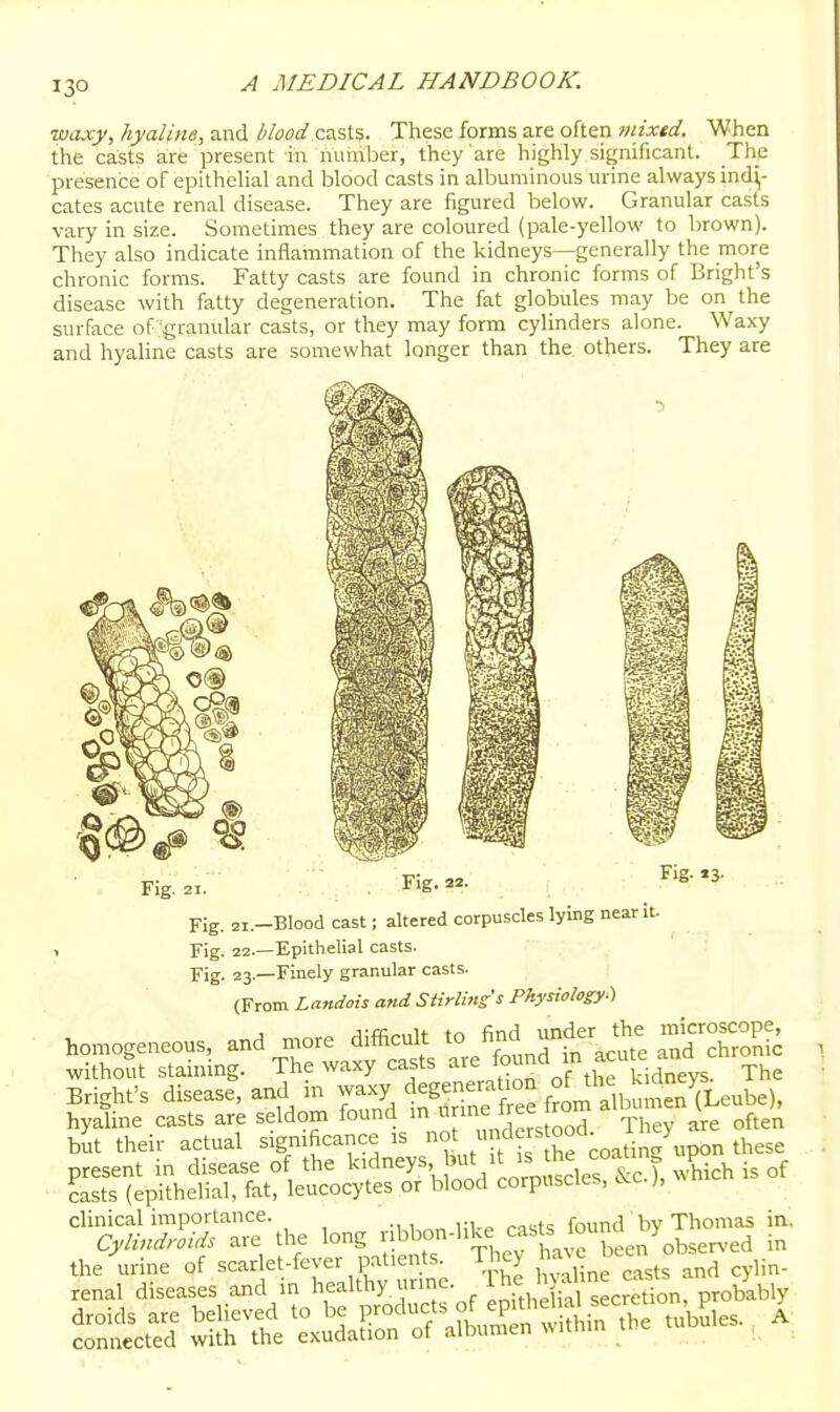 13° waxy, hyaline, and blood casts. These forms are often fiiixtd. When the casts are present m number, they are highly significant. The presence of epithehal and blood casts in albuminous urine always indi- cates acute renal disease. They are figured below. Granular casts vary in size. Sometimes they are coloured (pale-yellow to brown). They also indicate inflammation of the kidneys—generally the more chronic forms. Fatty casts are found in chronic forms of Bright's disease with fatty degeneration. The fat globules may be on the surface of granular casts, or they may form cylinders alone. Waxy and hyaline casts are somewhat longer than the others. They are Fig. 22. Fig. 2i.-Blood cast; altered corpuscles lying near it. > Fig. 22.—Epithelial casts. Fig. 23.—Finely granular casts. (From Landois and Stirlins's Physiology:) homogeneous, and more difficult to fi^d -d the microscop^^ without staining. The waxy casts are ^^'^ J^i^^^'tidneys. The Bright's disease, and in Slnff ee from^^^^^^^^^ hyaline casts are seldom found m «™f ° They are often but their actual significance is .^^^ ^° .o^tin^ upon these present in disease of the kidneys ^Vrormiscles &c T, which is of casts (epithelial, fat, leucocytes or blood corpuscles, cvc.,, clinical importance. -i 1 hi-p rasts found by Thomas in. Cylindroids are the long bb°n-like casU louna y