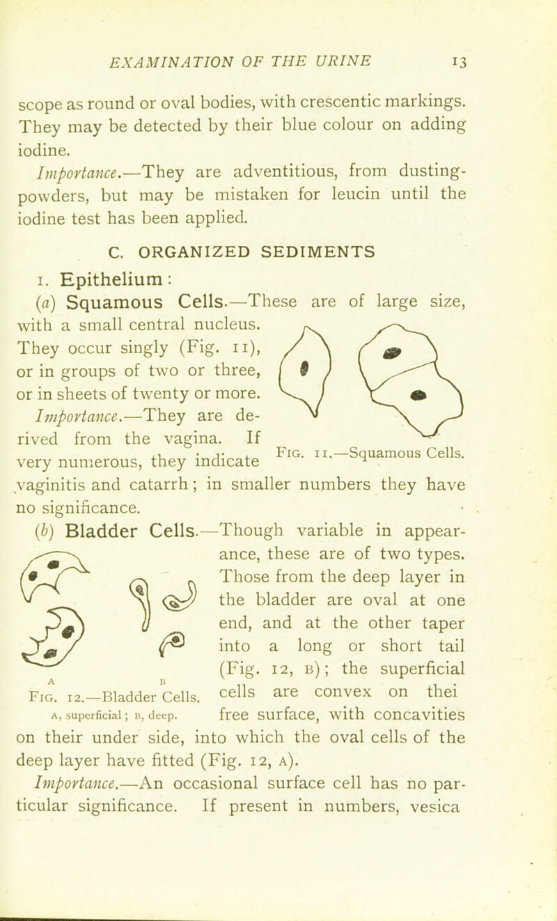 scope as round or oval bodies, with crescentic markings. They may be detected by their blue colour on adding iodine. Importance.—They are adventitious, from dusting- powders, but may be mistaken for leucin until the iodine test has been applied. C. ORGANIZED SEDIMENTS 1. Epithelium: (a) Squamous Cells.—These are of large size, with a small central nucleus. They occur singly (Fig. 11), or in groups of two or three, or in sheets of twenty or more. Importance.—They are de- rived from the vagina. If ,1 • 1 • 1 Fig. 11.—Squamous Cells, very numerous, they indicate ^ vaginitis and catarrh; in smaller numbers they have no significance. (b) Bladder Cells.—Though variable in appear- ance, these are of two types. Those from the deep layer in the bladder are oval at one D end, and at the other taper ^® into a long or short tail (Fig. 12, b) ; the superficial Fig. 12.—Bladder Cells. cells are convex on thei a, superficial; b, deep. free surface, with concavities on their under side, into which the oval cells of the deep layer have fitted (Fig. 12, a). Importance.—An occasional surface cell has no par- ticular significance. If present in numbers, vesica A U