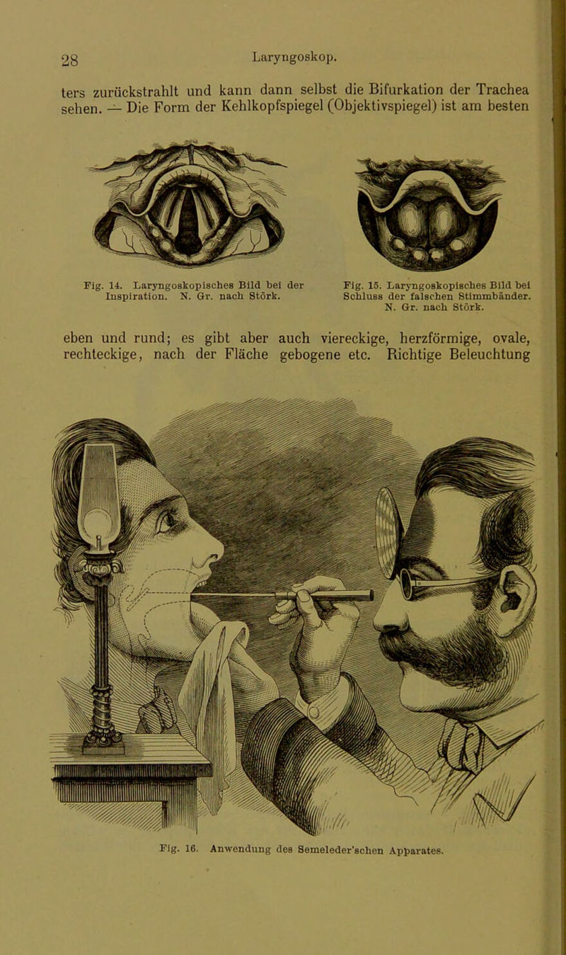 ters zurückstrahlt und kann dann selbst die Bifurkation der Trachea sehen. — Die Form der Kehlkopfspiegel (Objektivspiegel) ist am besten Fig. 14. Laryngoskopisches Bild bei der Fig. 15. Laryngoskopisches Bild bei Inspiration. N. Gr. nach Stork. Schluss der falschen Stimmbänder. N. Gr. nach Stork. eben und rund; es gibt aber auch viereckige, herzförmige, ovale, rechteckige, nach der Fläche gebogene etc. Richtige Beleuchtung Flg. 16. Anwendung des Semeleder'schen Apparates.