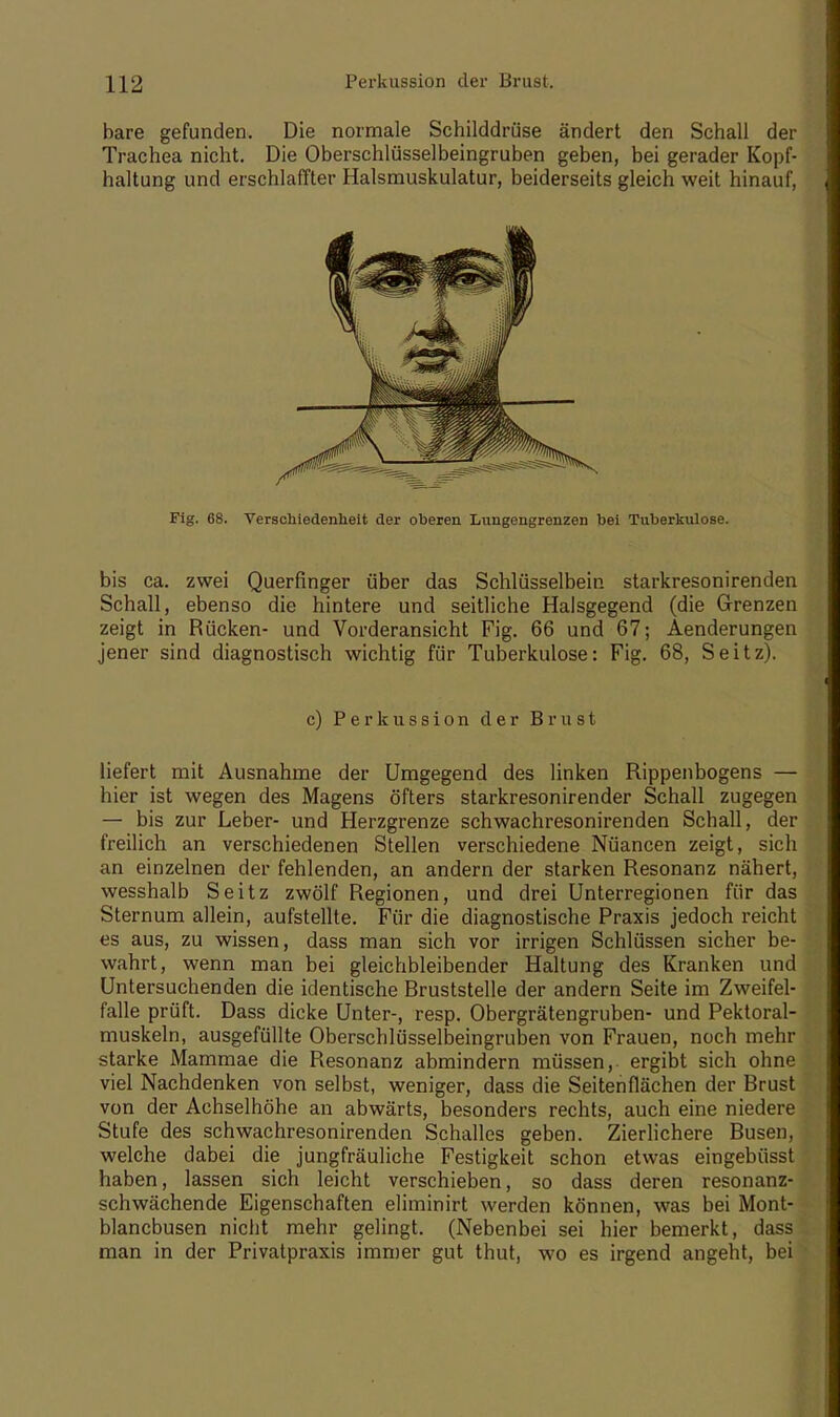 1X2 Perkussion der Brust. bare gefunden. Die normale Schilddrüse ändert den Schall der Trachea nicht. Die Oberschlüsselbeingruben geben, bei gerader Kopf- haltung und erschlaffter Halsmuskulatur, beiderseits gleich weit hinauf, Fig. 68. Verschiedenheit der oberen Lungengrenzen bei Tuberkulose. bis ca. zwei Querfinger über das Schlüsselbein starkresonirenden Schall, ebenso die hintere und seitliche Halsgegend (die Grenzen zeigt in Rücken- und Vorderansicht Fig. 66 und 67; Aenderungen jener sind diagnostisch wichtig für Tuberkulose: Fig. 68, Seitz). c) Perkussion der Brust liefert mit Ausnahme der Umgegend des linken Rippenbogens — hier ist wegen des Magens öfters starkresonirender Schall zugegen — bis zur Leber- und Herzgrenze schwachresonirenden Schall, der freilich an verschiedenen Stellen verschiedene Nüancen zeigt, sich an einzelnen der fehlenden, an andern der starken Resonanz nähert, wesshalb Seitz zwölf Regionen, und drei Unterregionen für das Sternum allein, aufstellte. Für die diagnostische Praxis jedoch reicht es aus, zu wissen, dass man sich vor irrigen Schlüssen sicher be- wahrt, wenn man bei gleichbleibender Haltung des Kranken und Untersuchenden die identische Rruststelle der andern Seite im Zweifel- falle prüft. Dass dicke Unter-, resp. Obergrätengruben- und Pektoral- muskeln, ausgefüllte Oberschlüsselbeingruben von Frauen, noch mehr starke Mammae die Resonanz abmindern müssen, ergibt sich ohne viel Nachdenken von selbst, weniger, dass die Seitenflächen der Brust von der Achselhöhe an abwärts, besonders rechts, auch eine niedere Stufe des schwachresonirenden Schalles geben. Zierlichere Busen, welche dabei die jungfräuliche Festigkeit schon etwas eingebüsst haben, lassen sich leicht verschieben, so dass deren resonanz- schwächende Eigenschaften eliminirt werden können, was bei Mont- blancbusen nicht mehr gelingt. (Nebenbei sei hier bemerkt, dass man in der Privatpraxis immer gut thut, wo es irgend angeht, bei