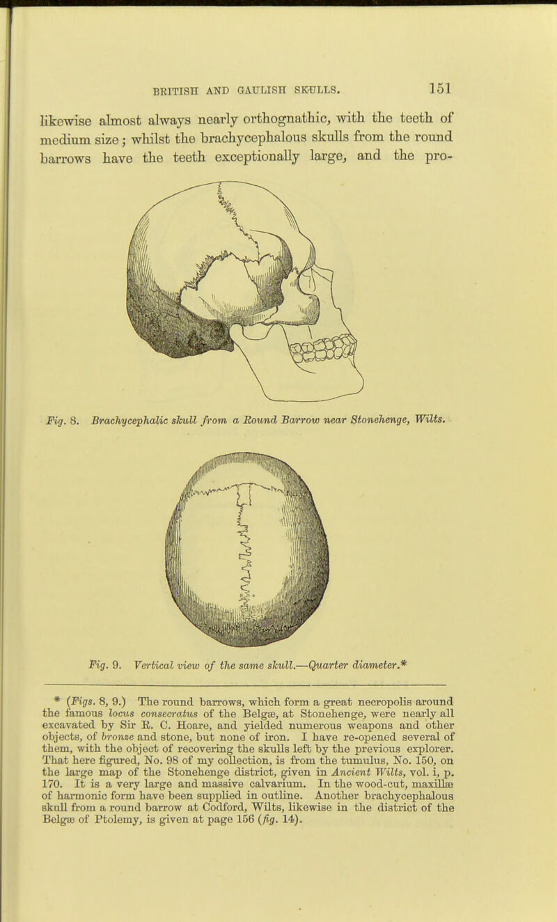 likewise almost always nearly ortliognatliic, with the teeth of medium size; whilst the brachycephalous skulls from the round barrows have the teeth exceptionally large, and the pro- Fig. 8. Br achy cephalic sTcull from a Bound Bcurrow near Stonehenge, Wilts. Fig. 9. Vertical view of the same skull.—Quarter diameter.* * (Figs. 8, 9.) The round barrows, wtich form a ^eat necropolis around the famous locus consecratus of the Belgse, at Stonehenge, were nearly all excavated by Sir K. C. Hoare, and yielded numerous weapons and other objects, of bronze and stone, but none of iron. I have re-opened several of them, with the object of recovering the skulls left by the previous explorer. That here figured. No. 98 of my collection, is from the tumulus, No. 150, on the large map of the Stonehenge district, given in Ancient Wilts, vol. i, p. 170. It is a very large and massive calvarium. In the wood-cut, maxilliD of harmonic form have been supplied in outline. Another brachycephalous skull from a round barrow at Codlbrd, WUts, likewise in the district of the Belga) of Ptolemy, is given at page 156 {fig. 14).