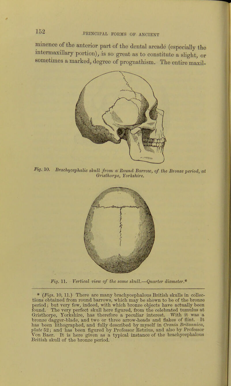 PRINCIPAL FORMS OF ANCIENT minence of the anterior part of the dental arcade (especially the intermaxillary portion), is so great as to constitute a slight, or sometimes a marked, degree of prognathism. The entire maxil- Fig, 10. BracliA/cephalic skull from a Round Ba/rrow, of the Bronze period, at Oristhorpe, Yorkshire. Fig. 11. Vertical view of the same skull.—Quarter diameter.* * (Figs. 10, 11.) There are many brachycephalous Britisli skulls in collec- tions obtained from round barrows, which may be shown to be of the bronze period; but very few, indeed, with which bronze objects have actually been found. The very perfect skull here figui'ed, fi'om the celebrated tumulus at Gristhoi-pe, Yorkshire, has therefore a peculiar interest. With it was a bronze dagger-blade, and two or three arrow-heads and flakes of flint. It has been lithographed, and fuUy described by myself in Crania Britannica, plate 52; and has been figured by Professor Eetzius, and also by Professor Von Baer. It is here given as a typical instance of the brachycephalous British skuU of the bronze period.