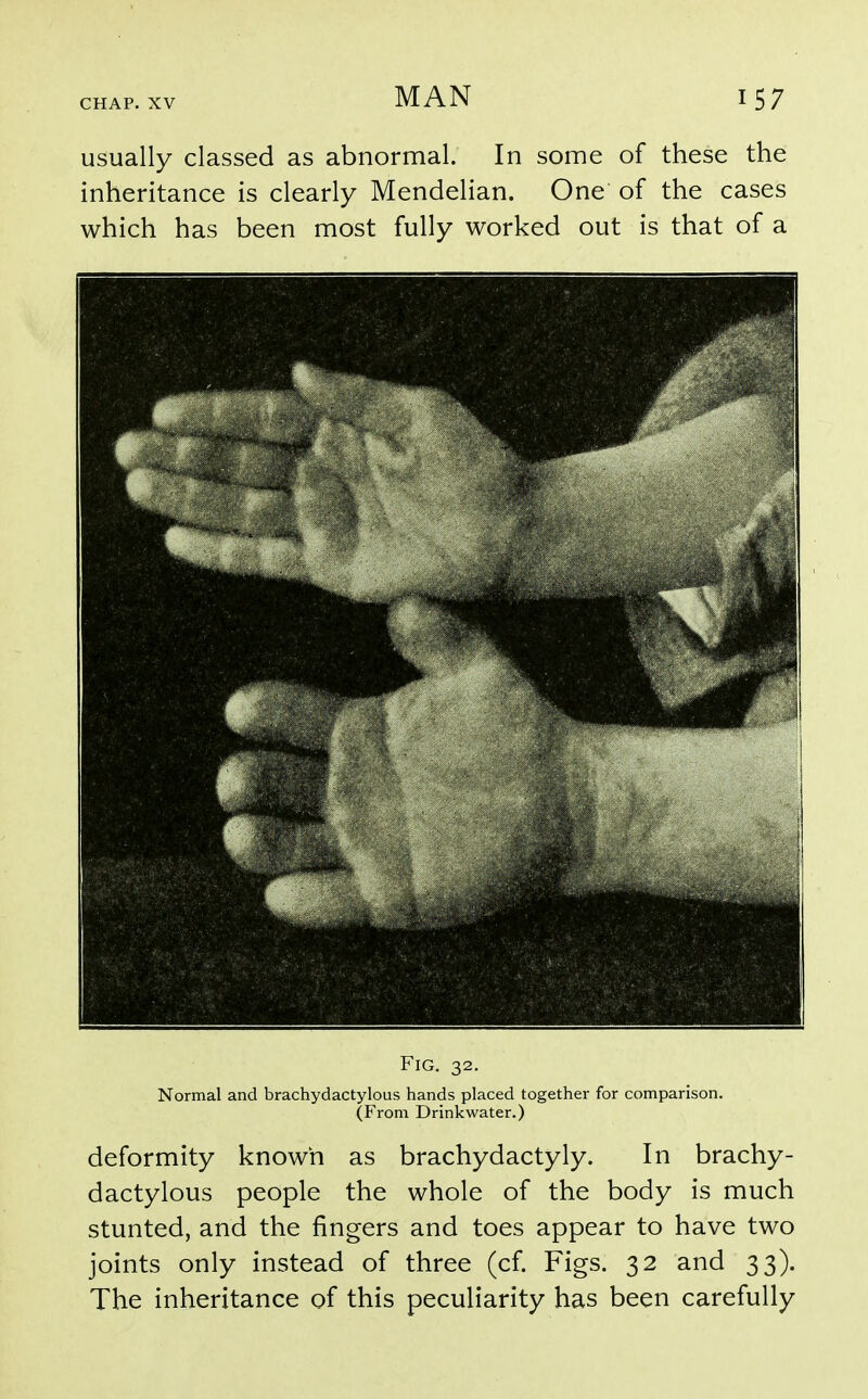 usually classed as abnormal. In some of these the inheritance is clearly Mendelian. One of the cases which has been most fully worked out is that of a Fig. 32. Normal and brachydactylous hands placed together for comparison. (From Drinkwater.) deformity known as brachydactyly. In brachy- dactylous people the whole of the body is much stunted, and the fingers and toes appear to have two joints only instead of three (cf. Figs. 32 and 33). The inheritance of this peculiarity has been carefully