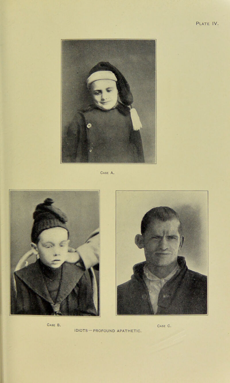 Case A. IDIOTS —PROFOUND APATHETIC.