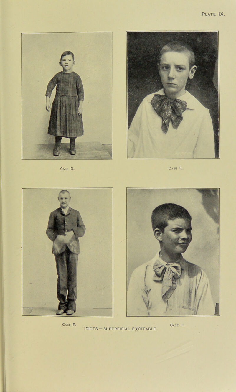 Case D. Case E. Case F. IDIOTS —SUPERFICIAL EXCITABLE. Case G.