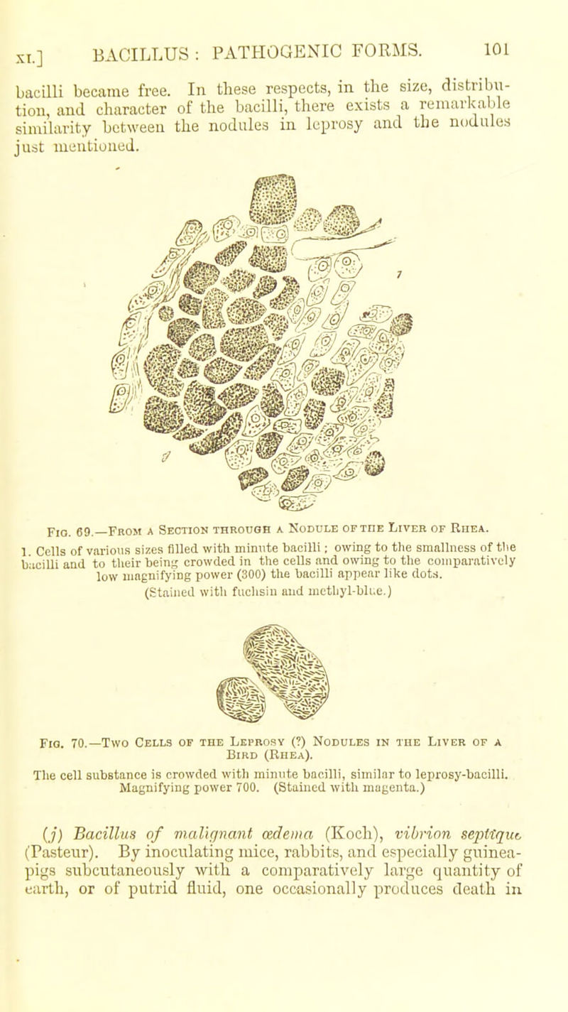 bacilli became free. In these respects, in the size, distribu- tion, and character of the bacilli, there exists a reiiuirkable simiUxrity between the nodules in leprosy and the nodules just mentioned. Fio, 69, From a Sectiok throcoh a Nodule or the Liver of Rhea. 1. Cells of various sizes filled with minute bacilli: owing to the sraallness of the bacilli and to their bein^ crowded in the cells and owing to the comparatively low Uiaenifying power (300) the bacilli appear lil<e dots. (Stained witli fuclisiu and mcthyl-bli.e.) Fio. 70.—Two Cells of the Leprosy (?) Nodules in the Liver of a Bird (Rhea). The cell substance is crowded with minute bacilli, similar to leprosy-bacilli. Magnifying power 700. (Stained with magenta.) (./) Bacillus of malignant cedeina (Koch), vibrion septtquc (Pasteur). By inoculating mice, rabbits, and especially guinea- pigs subcutaneously with a comparatively large quantity of earth, or of putrid fluid, one occasionally produces death in