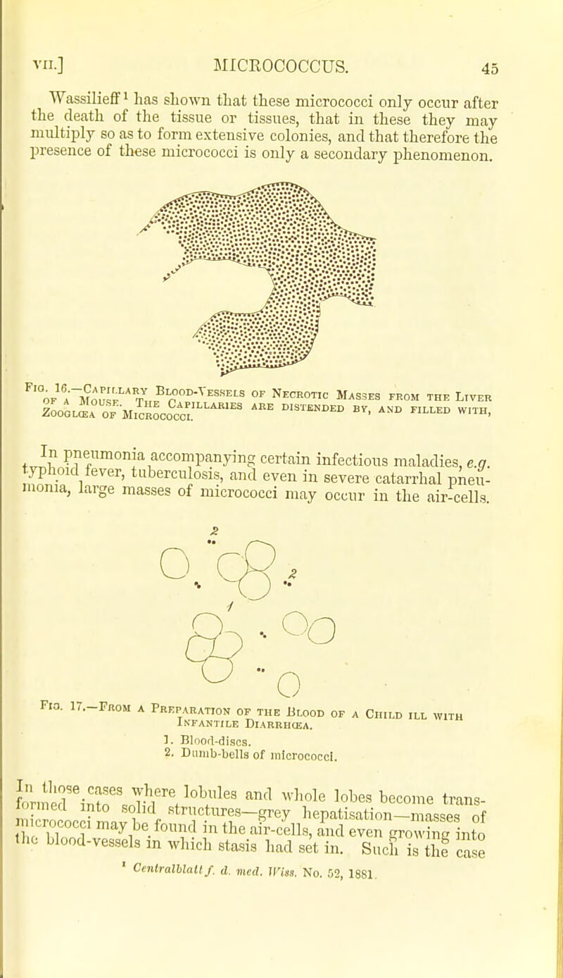 ■VVassilieff i has shown that these micrococci only occur after the death of the tissue or tissues, that in these they may multiply so as to form extensive colonies, and that therefore the presence of these micrococci is only a secondary phenomenon. 'of'I'IJou^f^Vh.^pfp'^'''^ °^ Necrotic Masses from the Liver ZooOL^'r OF MICROCOCCI.'''^''^' '^^^ ^'^^ In pneumonia accompanying certain infectious maladies, e.a. typhoid fever, tuberculosis, and even in severe catarrhal pneii- monia, large masses of micrococci may occur in the air-cells Fio. 17.-FR0M A Preparation of the Blood op a Child ill with Infantile Diarehcea. 1. Blood-discs. 2. Dumb-bells of micrococci. rnied into solid structures-grey hepatisatinn-masses of crococci may be found in the afr-cells, ind even growhig nto Iho blood-vessels in which stasis had set in. Such is Jhe case ■ Centralblalt f. d. med. V'iss. No. 02, 1881.