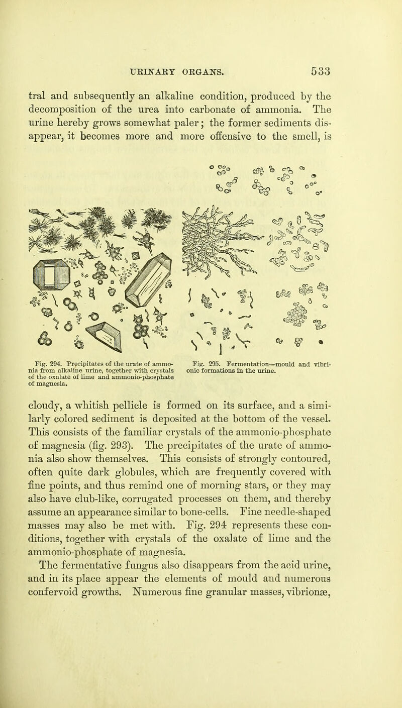 tral and subsequently an alkaline condition, produced by the decomposition of the urea into carbonate of ammonia. The urine hereby grows somewhat paler; the former sediments dis- appear, it becomes more and more offensive to the smell, is Fig. 294. Precipitates of the urate of ammo- nia from alkaline urine, together with crystals of the oxalate of lime and ammouio-phosphate of magnesia. Fig. 295. Fermentation—mould and vibrl- onic formations in the urine. cloudy, a whitish pellicle is formed on its surface, and a simi- larly colored sediment is deposited at the bottom of the vessel. This consists of the familiar crystals of the ammonio-phosphate of magnesia (fig. 293). The precipitates of the urate of ammo- nia also show themselves. This consists of strongly contoured, often quite dark globules, which are frequently covered with fine points, and thus remind one of morning stars, or they may also have club-like, corrugated processes on them, and thereby assume an appearance similar to bone-cells. Fine needle-shaped masses may also be met with. Fig. 294 represents these con- ditions, together with crystals of the oxalate of lime and the ammonio-phosphate of magnesia. The fermentative fungus also disappears from the acid urine, and in its place appear the elements of mould and numerous conf ervoid growths. Numerous fine granular masses, vibrionse,