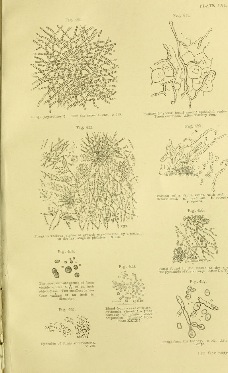 Fie-. 42*). 1/  Fun^i (aspergnius ') From the external ear. X 215. ^un^us (mycelial form) among epitlielial scales.: ^ TiueZcircinata. After TilbniT Fox. ] Fig. 423. Fungi in various stages of ^rowt^ expectorated by a patient in the last stage of plithisis. X 2io. Fig. 424. Tlie most minute germs of fungi visible under a -go ^f an incb object-glass. Ttie smallest is less Lban TooBoo of an incli in diameter. Fig. 428. Fig. 425. Blood from a case of leuco cythemia. sbowing a great number of wbite blood corpuscles- (Omixted from Plate SXIX.) J 0 ^ Portion of a favns ci-ust.. with Achor Schoenleinii. a. mycelixim. 6, recepta c, spores. Fig. 426. I Fungi found in the tissue at the ape tte pyramids of the kidney. After Dr. Tc Snorules of fungi and bacteria. ^ X 215. Fungi from the kidney. X TOC. Afte. Tonge. [To face page
