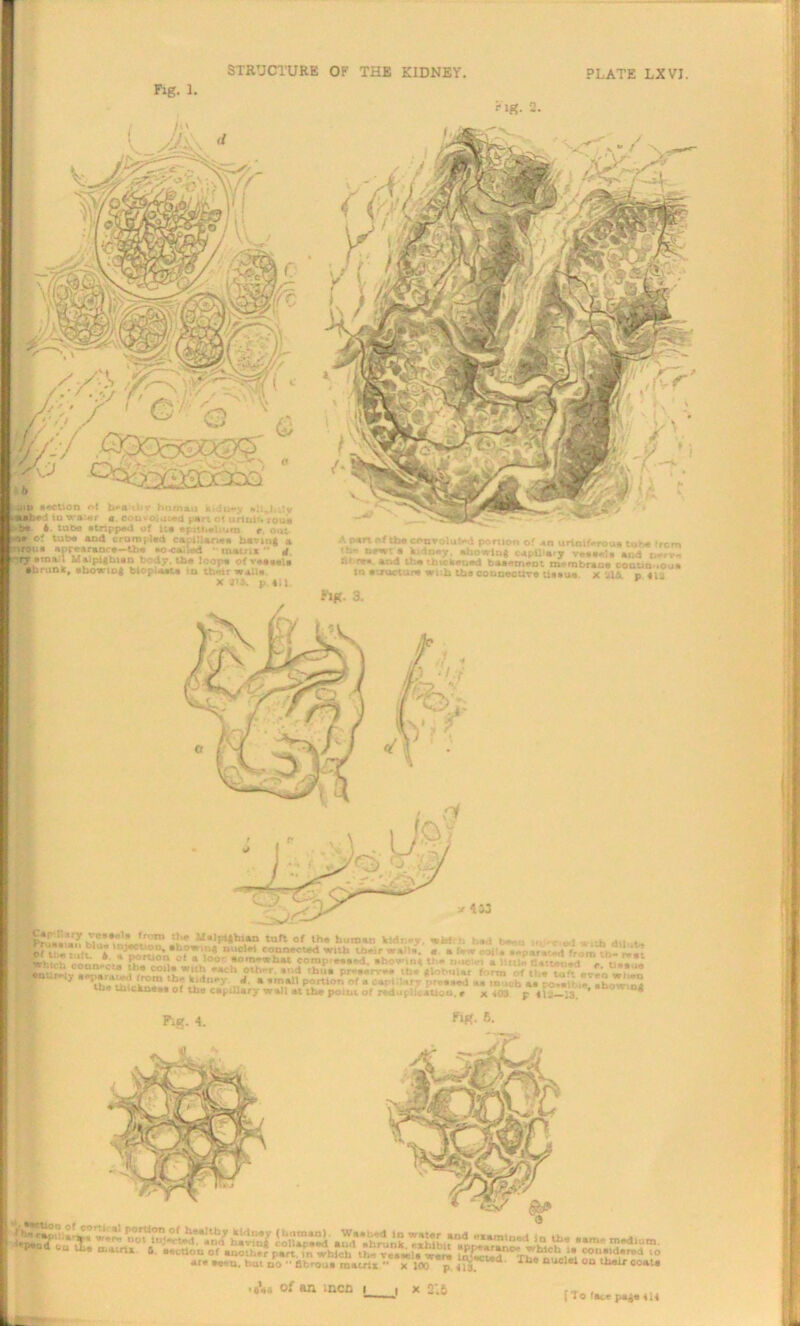 STRUCTURE OF THE KIDNEY. Fig. 1. PLATE LX VI. F lg. 2. ,j«u section •*{ fee* thy human m iu-v fchjjilv eebed iu WV«f a Coo«olai*d *art ot urluit. r0a» b« 6 tube stripped of i:e epithelium e. out “• of tube and crumpled cacxillariee having a nroua appearance—the eo-caUed ' mitnt  U rrj email Malpighian body, the loop* of vessels Shrunk, showing bioplasts in their wail* X its. p. ill. Apert of the convoluted portion of an urim'-rous tube from newt • kidney, showing capllle.y veeeela end nerve in rv». and the thickened basement membrane coDtm-ioua in structure wuh the connective tissue X ulfi. p fig Fig. 3. V 4 S3 '’■* Stalpighian tuft of the human kfcJu.y. wnft !i had b.-,, . c ^ ^llb even when 6 k .♦ 7 . ronnecteci witn tneir we Me. e a lew rot * separated frv \r) ieh Mnn.'^! Portion *kloor: •om-what comp'ens^d. showing the nuclei a little tlstteu-rt «Wh,ch coon.« . th.CO, .»,1n„d, «l,r..„d tbu. pwm. th.\lob„l„ fo™, of ,.‘a^ft raie<l Ircin the k 111 fie V A ■ email nnrtlnn nf . 1 .... . . •OIIMV .™„ kT. *•“> ouwr. ai l thu. pr-a.rv— <h. glotmlar fom, of tl.a tuft . * *L a »mall portion of a cart.Urv prr.aod aa much a. tx>»al(.i« thovini ha uuchn... of tho cajiU.ry wall at the point of reduplication, r x 403 p 410—13 * ^ Fig. 4. F>g. 6. VifIS0'1.0! «or> »1 portion of haalth' '‘Tf* »« »« t-.WW. anti paoa uU Ui< mum s. .ottlou of are «c-u. hut no * >oV. of an »ncl i t x 21fi ( 7o (ece pa** 414