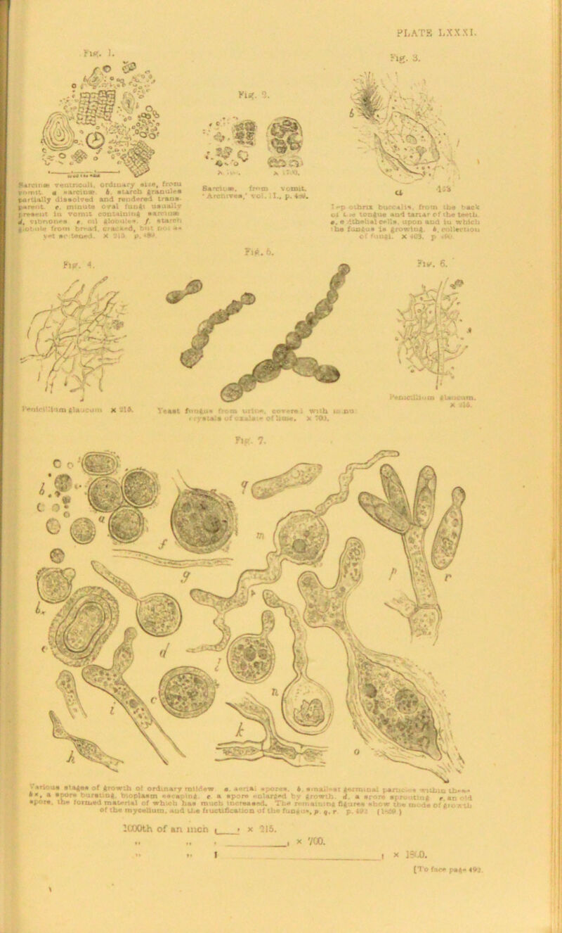 Lip;. I. 5**rcw-ue veutnculi. ordruary »U«, from fromtt « «aroo«e. b. atarcb ftraoulf* partially dissolved and rendered trane parent. r mmuta oral fungi uauallv LrHvut iu vomit containing tanniifc d, \ ibnon**# r. oil gloom***. / atarr' g.otule from bf>-Ai. cracked, bu' D* ■** v«*t ac taned. X 'Jib p. *9^ Ki*. 2. X Vi*- . ■ 8*tu b. fmtn vomit. •Archive#/ vol. I., y. irt. rig. a. T »-p c -Jmx buccahv from tbe back ol c .« tongue and tartar of the teeth, a. • dtbohal eella. upon and iu which he fongua i» growing. A. collection of fuo&i. x <403. p »*V Fi«. 5. Fir. 7. Yeaat fungju* from wrlta*. cover# j with luto « : yataJa of oxalate of lime. X TO). ^ arioue stage# of growth of ordinary mildew a. aer.aj apore*. 6 ainal'- «t germinal panu. i within th-»» • a spore > iratiug • -rlasm *•*<•# ml r a apore enlarged tv |r< wth. d a »: •- a;.*. t. . /«.. d spore, the formed material of which baa much increased. Tbe remaining figure# *how the in de of growth Of tbe mycelium, aud the fructification of the fuo&u*. p q. r y. is (1 -J/s ) 1100th of an men | > x 515. x 700. i x 1 <HJ0.