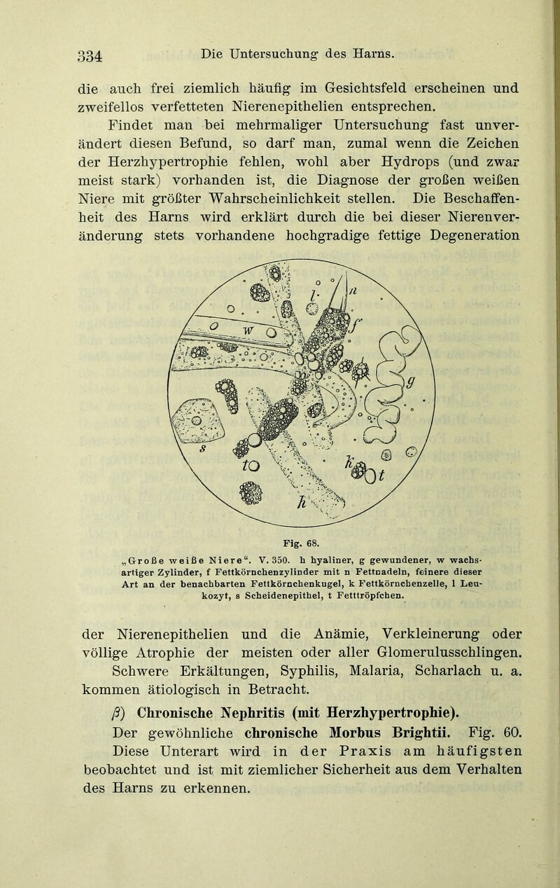 die auch frei ziemlich häufig im Gesichtsfeld erscheinen und zweifellos verfetteten Nierenepithelien entsprechen. Findet man bei mehrmaliger Untersuchung fast unver- ändert diesen Befund, so darf man, zumal wenn die Zeichen der Herzhypertrophie fehlen, wohl aber Hydrops (und zwar meist stark) vorhanden ist, die Diagnose der großen weißen Niere mit größter Wahrscheinlichkeit stellen. Die Beschaffen- heit des Harns wird erklärt durch die hei dieser Nierenver- änderung stets vorhandene hochgradige fettige Degeneration „Große weiße Niere“. V. 350. h hyaliner, g gewundener, w wachs- artiger Zylinder, f Fettkörnchenzylinder mit n Fettnadeln, feinere dieser Art an der benachbarten Fettkörnchenkugel, k Fettkörnchenzelle, 1 Leu- kozyt, s Scheidenepithel, t Fetttröpfchen. der Nierenepithelien und die Anämie, Verkleinerung oder völlige Atrophie der meisten oder aller Glomerulusschlingen. Schwere Erkältungen, Syphilis, Malaria, Scharlach u. a. kommen ätiologisch in Betracht. ß) Chronische Nephritis (mit Herzhypertrophie). Der gewöhnliche chronische Morbus Brightii. Fig. 60. Diese Unterart wird in der Praxis am häufigsten beobachtet und ist mit ziemlicher Sicherheit aus dem Verhalten des Harns zu erkennen.