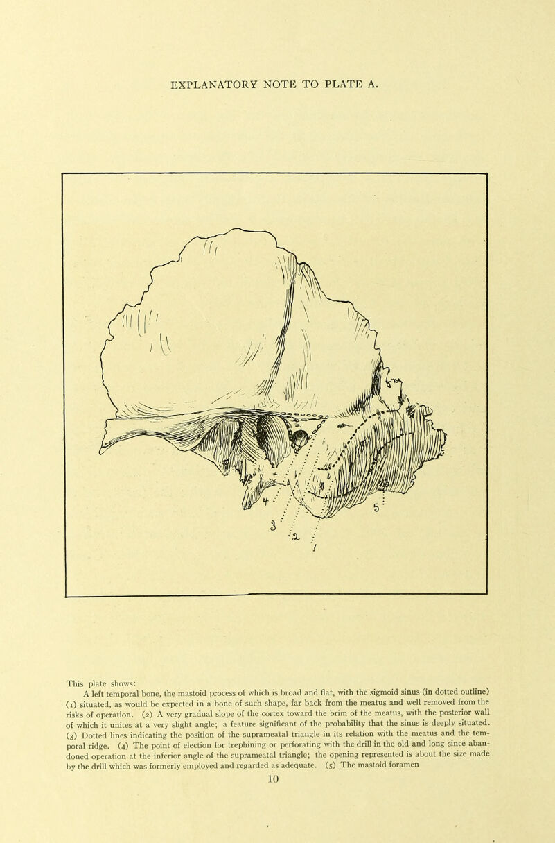 EXPLANATORY NOTE TO PLATE A. This plate shows: A left temporal bone, the mastoid process of which is broad and flat, with the sigmoid sinus (in dotted outline) (r) situated, as would be expected in a bone of such shape, far back from the meatus and well removed from the risks of operation. (2) A very gradual slope of the cortex toward the brim of the meatus, with the posterior wall of which it unites at a very sUght angle; a feature significant of the probability that the sinus is deeply situated. (3) Dotted Hues indicating the position of the supramcatal triangle in its relation with the meatus and the tem- poral ridge. (4) The point of election for trephining or perforating with the drill in the old and long since aban- doned operation at the inferior angle of the suprameatal triangle; the opening represented is about the size made by the drill wliich was formerly employed and regarded as adequate. (5) The mastoid foramen io