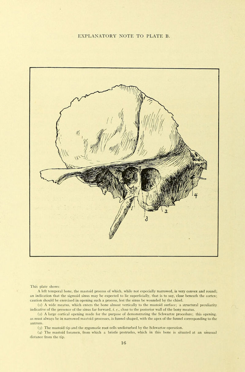 EXPLANATORY NOTE TO PLATE B. This plate shows: A left temporal bone, the mastoid process of which, while not especially narrowed, is very convex and round; an indication that the sigmoid sinus may be expected to he superficially, that is to say, close beneath the cortex; caution should be exercised in opening such a process, lest the sinus be wounded by the chisel. (1) A wide meatus, which enters the bone almost vertically to the mastoid surface; a structural peculiarity indicative of the presence of the sinus far forward, i. c, close to the posterior wall of the bony meatus. (2) A large cortical opening made for the purpose of demonstrating the Schwartze procedure; this opening, as must always be in narrowed mastoid processes, is funnel-shaped, with the apex of the funnel corresponding to the antrum. (3) The mastoid tip and the zygomatic root cells undisturbed by the Schwartze operation. (4) The mastoid foramen, from which a bristle protrudes, which in this bone is situated at an unusual distance from the tip.
