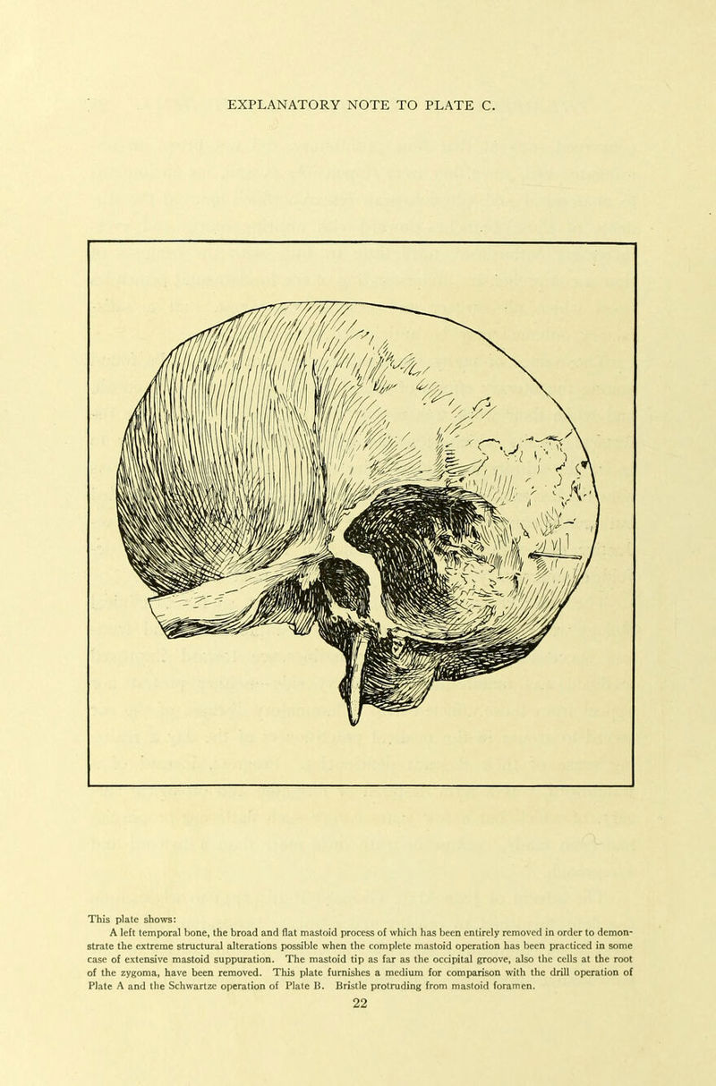 EXPLANATORY NOTE TO PLATE C. This plate shows: A left temporal bone, the broad and flat mastoid process of which has been entirely removed in order to demon- strate the extreme structural alterations possible when the complete mastoid operation has been practiced in some case of extensive mastoid suppuration. The mastoid tip as far as the occipital groove, also the cells at the root of the zygoma, have been removed. This plate furnishes a medium for comparison with the drill operation of Plate A and the Schwartzc operation of Plate B. Bristle protruding from mastoid foramen.