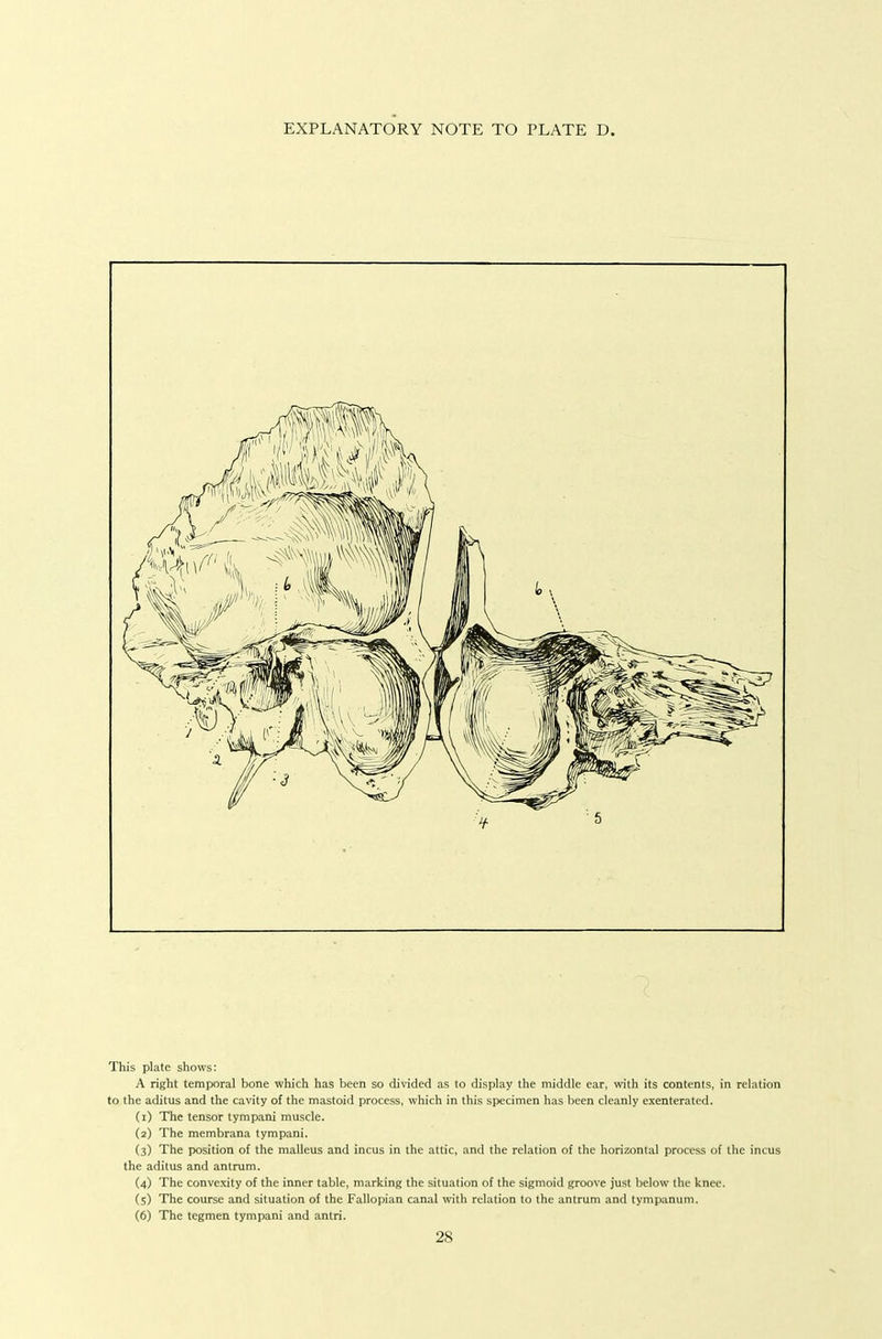 EXPLANATORY NOTE TO PLATE D. This plate shows: A right temporal bone which has been so divided as to display the middle ear, with its contents, in relation to the aditus and the cavity of the mastoid process, which in this specimen has been cleanly exenterated. (1) The tensor tympani muscle. (2) The membrana tympani. (3) The position of the malleus and incus in the attic, and the relation of the horizontal process of tlic incus the aditus and antrum. (4) The convexity of the inner table, marking the situation of the sigmoid groove just below the knee. (5) The course and situation of the Fallopian canal with relation to the antrum and tympanum. (6) The tegmen tympani and antri.