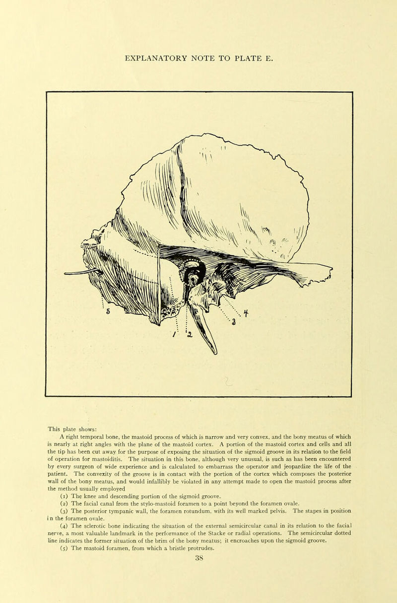 EXPLANATORY NOTE TO PLATE E. ? This plate shows: A right temporal bone, the mastoid process of which is narrow and very convex, and the liony meatus of which is nearly at right angles with the plane of the mastoid cortex. A portion of the mastoid cortex and cells and all the tip has been cut away for the purpose of exposing the situation of the sigmoid groove in its relation to the field of operation for mastoiditis. The situation in this bone, although very unusual, is such as has been encountered by every surgeon of wide experience and is calculated to embarrass the operator and jeopardize the life of the patient. The convexity of the groove is in contact with the portion of the cortex which composes the posterior wall of the bony meatus, and would infallibly be violated in any attempt made to open the mastoid process after the method usually employed (1) The knee and descending portion of the sigmoid groove. (2) The facial canal from the stylo-mastoid foramen to a point beyond the foramen ovale. (3) The posterior tympanic wall, the foramen rotundum. with its well marked pelvis. The stapes in position i n the foramen ovale. (4) The sclerotic bone indicating the situation of the external semicircular canal in its relation to the facial nerve, a most valuable landmark in the performance of the Stacke or radial operations. The semicircular dotted line indicates the former situation of the brim of the bony meatus; it encroaches upon the sigmoid groove. (5) The mastoid foramen, from which a bristle protrudes.