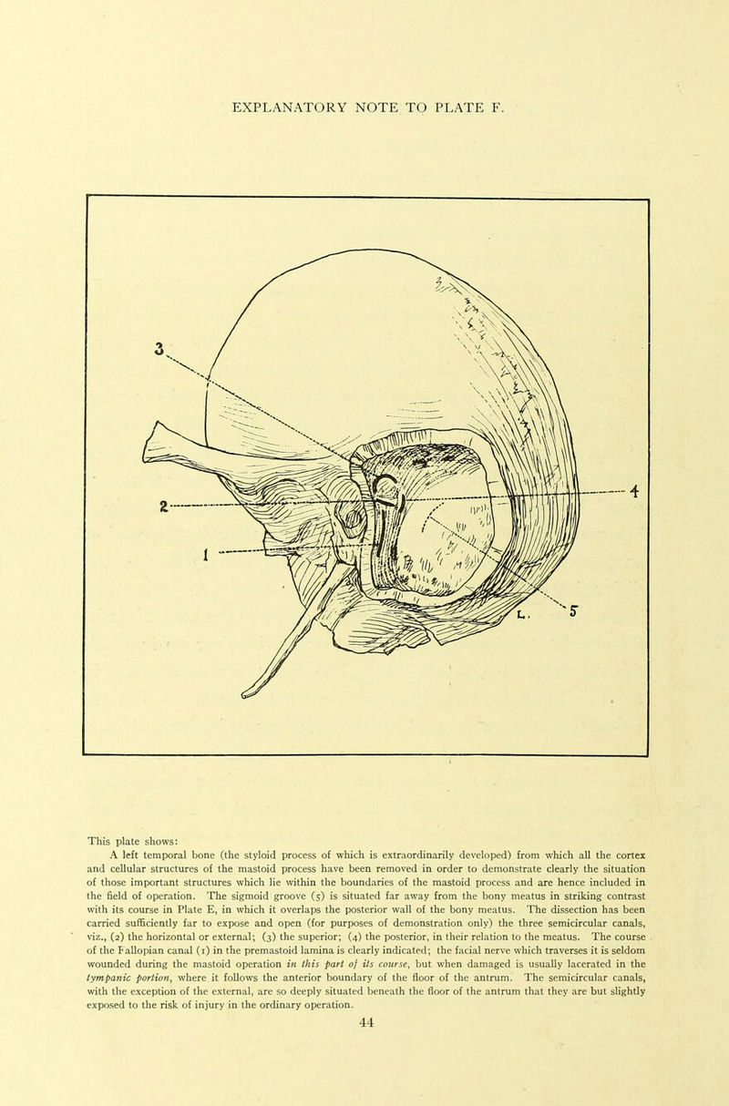 EXPLANATORY NOTE TO PLATE F. This plate shows: A left temporal bone (the styloid process of which is extraordinarily developed) from which all the cortex and cellular structures of the mastoid process have been removed in order to demonstrate clearly the situation of those important structures which lie within the boundaries of the mastoid process and are hence included in the field of operation. The sigmoid groove (s) is situated far away from the bony meatus in striking contrast with its course in Plate E, in which it overlaps the posterior wall of the bony meatus. The dissection has been carried sufficiently far to expose and open (for purposes of demonstration only) the three semicircular canals, viz., (2) the horizontal or external; (3) the superior; (4) the posterior, in their relation to the meatus. The course of the F allopian canal (i) in the premastoid lamina is clearly indicated; the facial nerve which traverses it is seldom wounded during the mastoid operation in this pari oj its course, but when damaged is usually lacerated in the tympanic portion, where it follows the anterior boundary of the floor of the antrum. The semicircular canals, with the exception of the external, are so deeply situated beneath the floor of the antrum that they are but slightly exposed to the risk of injury in the ordinary operation.