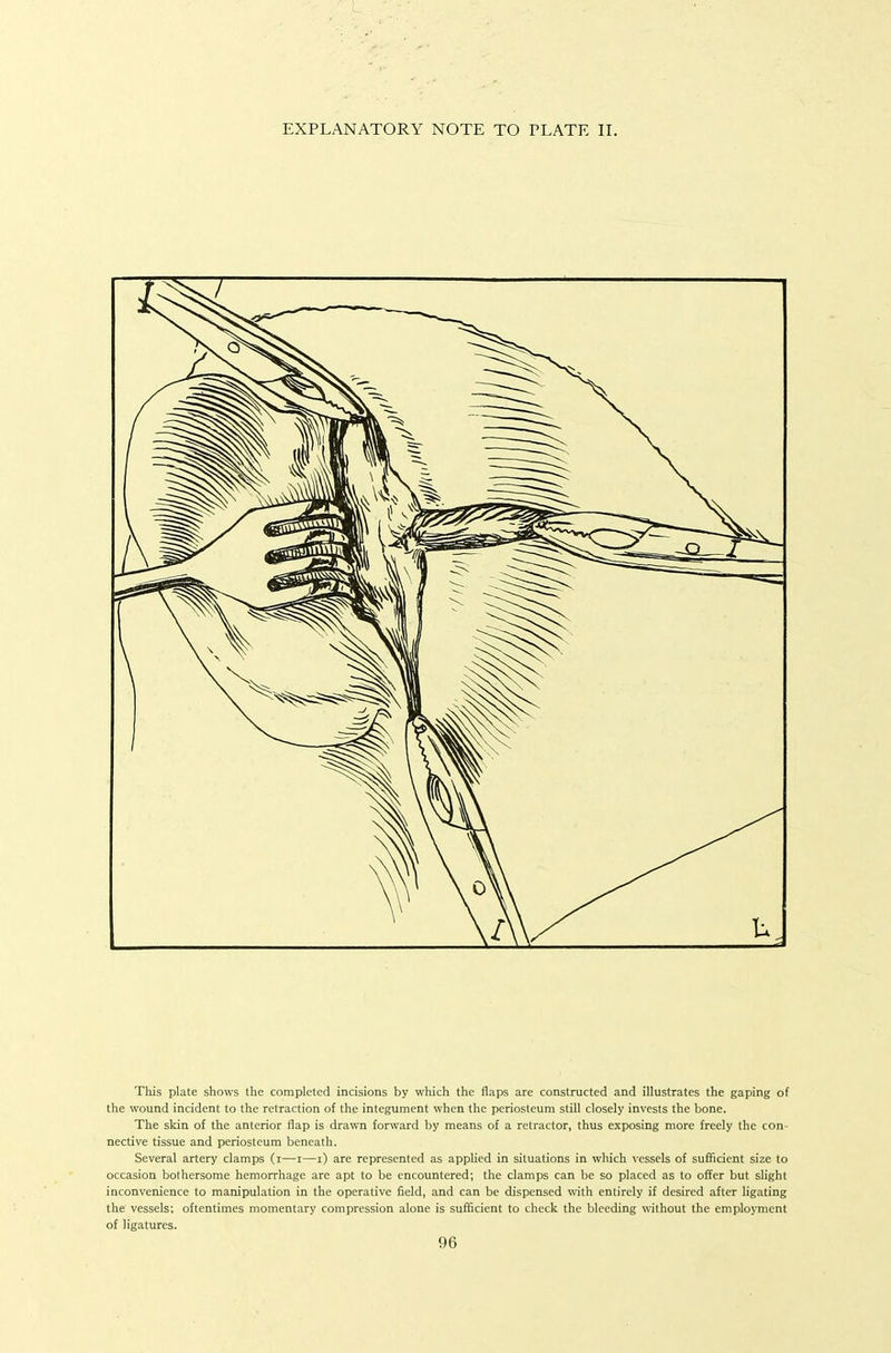 This plate shows the completed incisions by which the flaps are constructed and illustrates the gaping of the wound incident to the retraction of the integument when the periosteum still closely invests the bone. The skin of the anterior flap is drawn forward by means of a retractor, thus exposing more freely the con- nective tissue and periosteum beneath. Several artery clamps (i—i—i) are represented as applied in situations in which vessels of sufficient size to occasion bothersome hemorrhage are apt to be encountered; the clamps can be so placed as to offer but slight inconvenience to manipulation in the operative field, and can be dispensed with entirely if desired after ligating the vessels; oftentiines momentary compression alone is sufficient to check the bleeding without the employment of ligatures.