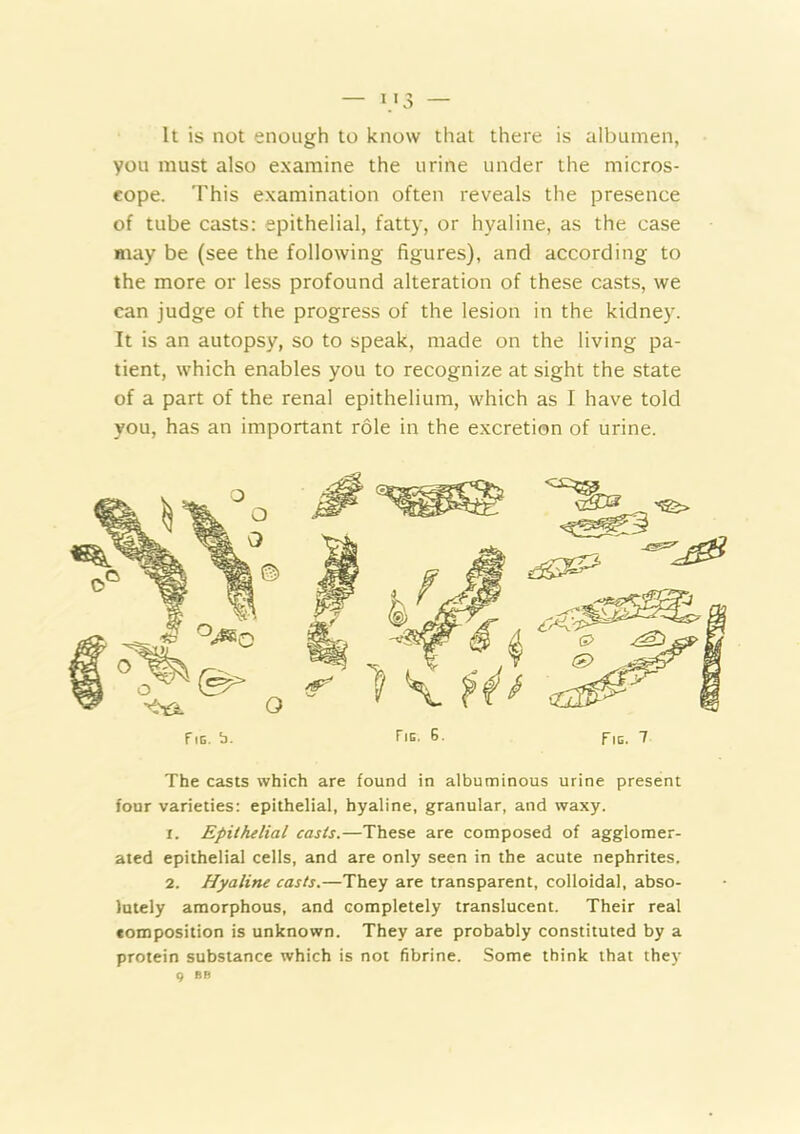 It is not enough to know that there is albumen, you must also examine the urine under the micros- cope. This examination often reveals the presence of tube casts: epithelial, fatty, or hyaline, as the case may be (see the following figures), and according to the more or less profound alteration of these casts, we can judge of the progress of the lesion in the kidney. It is an autopsy, so to speak, made on the living pa- tient, which enables you to recognize at sight the state of a part of the renal epithelium, which as I have told you, has an important role in the excretion of urine. The casts which are found in albuminous urine present four varieties: epithelial, hyaline, granular, and waxy. 1. Epithelial casts.—These are composed of agglomer- ated epithelial cells, and are only seen in the acute nephrites. lutely amorphous, and completely translucent. Their real composition is unknown. They are probably constituted by a protein substance which is not fibrine. Some think that they Fie. b. Fie. G. Fib. ^