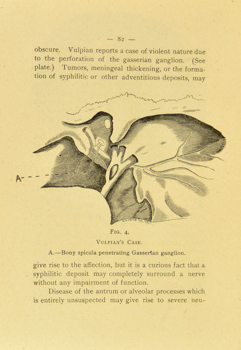 obscure. Vulpian reports a case of violent nature due to the perforation of the gasserian ganglion. (See plate.) Tumors, meningeal thickening, or the forma- tion of syphilitic or other adventitious deposits, may Fig. 4. Vuxpian’s Case. A.—Bony spicula penetrating Gasserian ganglion. give rise to the affection, but it is a curious fact that a syphilitic deposit may completely surround a nerve without any impairment of function. Disease of the antrum or alveolar processes which is entirely unsuspected may give rise to severe neu-