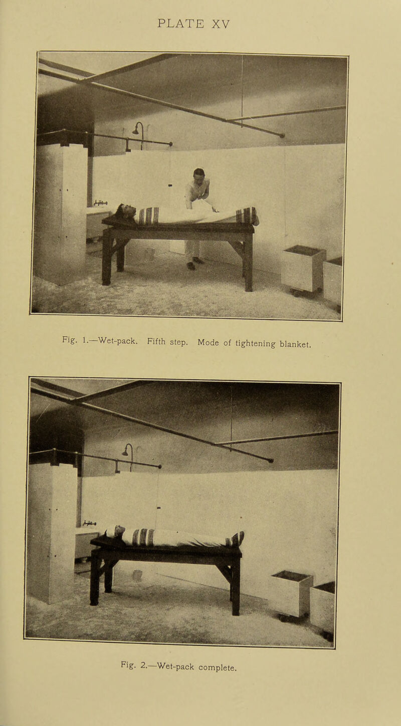 Fig. 1. Wet-pack. Fifth step. Mode of tightening blanket. Fig. 2.—Wet-pack complete.