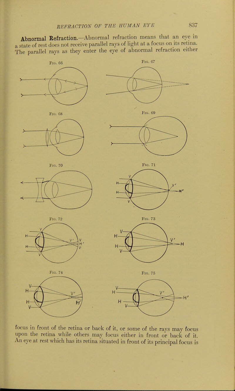 Abnormal Refraction—Abnormal refraction means that an eye in a state of rest does not receive parallel rays of light at a focus on its retina. The parallel rays as they enter the eye of abnormal refraction either Fig. 66 Fia. 67 focus in front of the retina or back of it, or some of the rays may focus upon the retina while others may focus either in front or back of it. An eye at rest which has its retina situated in front of its principal focus is