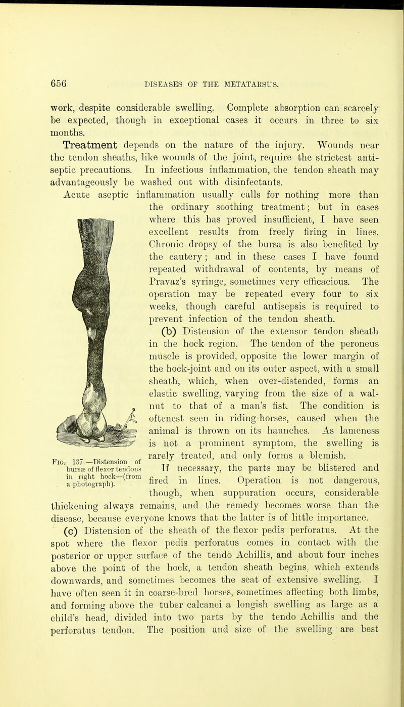 work, despite considerable swelling. Complete absorption can scarcely be expected, though in exceptional cases it occurs in three to six months. Treatment depends on the nature of the injury. Wounds near the tendon sheaths, like wounds of the joint, require the strictest anti- septic precautions. In infectious inflammation, the tendon sheath may advantageously be washed out with disinfectants. Acute aseptic inflammation usually calls for nothing more than the ordinary soothing treatment; but in cases where this has proved insufficient, I have seen excellent results from freely firing in lines. Chronic dropsy of the bursa is also benefited by the cautery; and in these cases I have found repeated withdrawal of contents, by means of Pravaz's syringe, sometimes very efficacious. The operation may be repeated every four to six weeks, though careful antisepsis is required to prevent infection of the tendon sheath. (b) Distension of the extensor tendon sheath in the hock region. The tendon of the peroneus muscle is provided, opposite the lower margin of the hock-joint and on its outer aspect, with a small sheath, which, when over-distended, forms an elastic swelling, varying from the size of a wal- nut to that of a man's fist. The condition is oftenest seen in riding-horses, caused when the animal is thrown on its haunches. As lameness is hot a prominent symptom, the swelling is rarely treated, and only forms a blemish. If necessary, the parts may be blistered and fired in lines. Operation is not dangerous, though, when suppuration occurs, considerable thickening always remains, and the remedy becomes worse than the disease, because everyone knows that the latter is of little importance. (c) Distension of the sheath of the flexor pedis perforatus. At the spot where the flexor pedis perforatus comes in contact with the posterior or upper surface of the tendo Achillis, and about four inches above the point of the hock, a tendon sheath begins,, which extends downwards, and sometimes becomes the seat of extensive swelling. I have often seen it in coarse-bred horses, sometimes affecting both limbs, and forming above the tuber calcanei a longish swelling as large as a child's head, divided into two parts by the tendo Achillis and the perforatus tendon. The position and size of the swelling are best Fig. 137.—Distension of 'bursse of flexor tendons in right hock—(from a photograph).