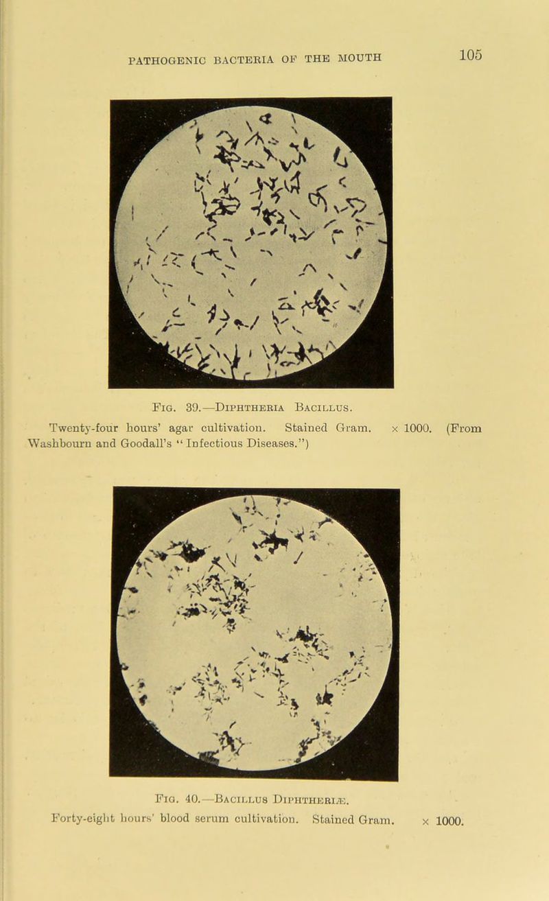 Fig. 39.—Diphtheria Bacillus. Twenty-four hours’ agar cultivation. Stained Gram. x 1000. (From Washbourn and Goodall’s “ Infectious Diseases.”) Fig. 40.—Bacillus Diphtherias. Forty-eight hours' blood serum cultivation. Stained Gram. x 1000.