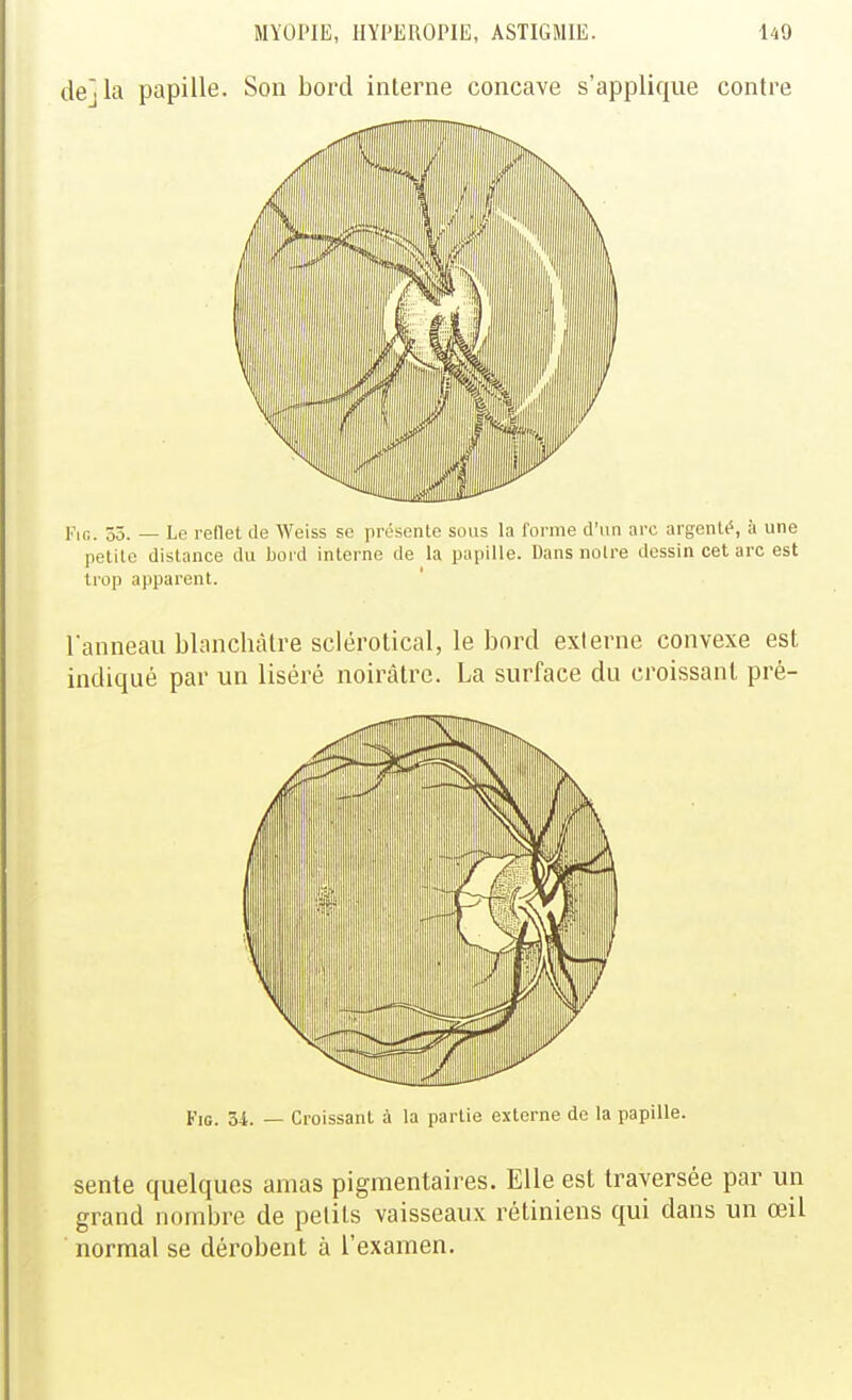 de] la papille. Son bord interne concave s'applique contre FiG. 55. — Le redet de Weiss se présente sous la rornie d'un arc argenU\ à une petite dislance du bord interne de la papille. Dans noire dessin cet arc est trop apparent. l'anneau blanchâtre sclérotical, le bord externe convexe est indiqué par un liséré noircâlre. La surface du croissant pré- FiG. 54. — Croissant à la partie externe de la papille. sente quelques amas pigmentaires. Elle est traversée par un grand nombre de petits vaisseaux rétiniens qui dans un œil normal se dérobent à l'examen.