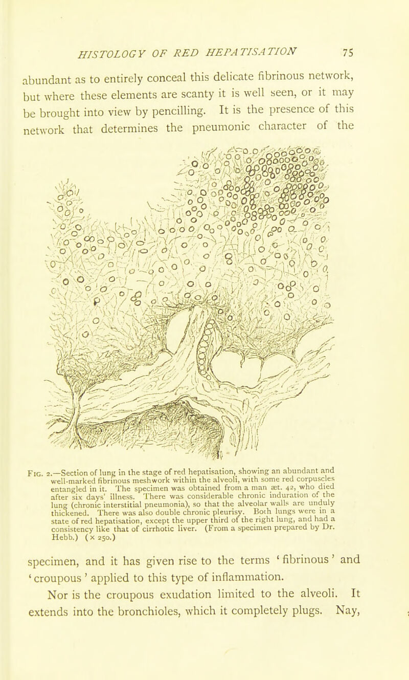 abundant as to entirely conceal this delicate fibrinous network, but where these elements are scanty it is well seen, or it may be brought into view by pencilling. It is the presence of this network that determines the pneumonic character of the Fig. 2.—Section of lung in the stage of red hepatisation, showing an abundant and well-marked fibrinous meshwork within the alveoli, with some red corpuscles entangled in it. The specimen was obtained from a man aet. 42, who died after six days' illness. There was considerable chronic induration of the lung (chronic interstitial pneumonia), so that the alveolar walls are unduly thickened. There was also double chronic pleurisy. Both lungs were m a state of red hepatisation, except the upper third of the right lung, and had a consistency like that of cirrhotic liver. (From a specimen prepared by Dr. Hebb.) (X250.) specimen, and it has given rise to the terms ' fibrinous' and ' croupous ' applied to this type of inflammation. Nor is the croupous exudation limited to the alveoli. It extends into the bronchioles, which it completely plugs. Nay,