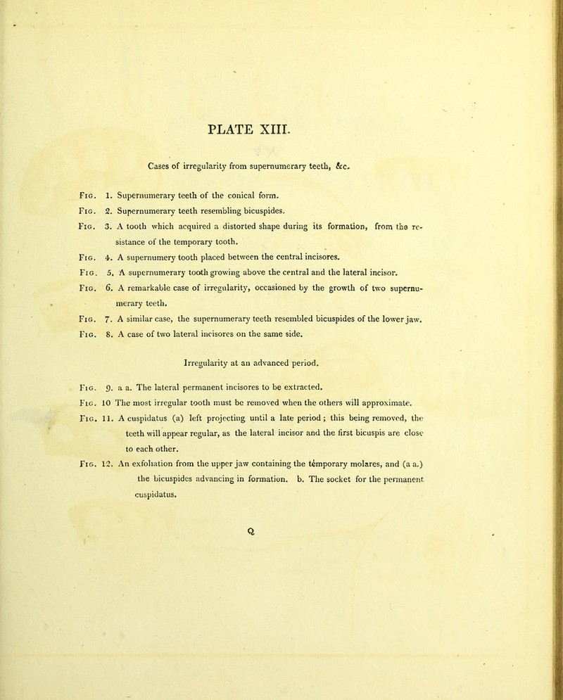 PLATE XIII. Fig. Fig. Fig. Fig. Fig. Fig. Fig. Fig. Fig. Fig. Fig. Fig. Cases of irregularity from supernumerary teeth, &c. 1. Supernumerary teeth of the conical form. 2. Supernumerary teeth resembling bicuspides. 3. A tooth which acquired a distorted shape during its formation, from the re- sistance of the temporary tooth. 4. A supernumery tooth placed between the central incisores. 5. A supernumerary tooth growing above the central and the lateral incisor. 6. A remarkable case of irregularity, occasioned by the growth of two supernu- merary teeth. 7. A similar case, the supernumerary teeth resembled bicuspides of the lower jaw. 8. A case of two lateral incisores on the same side. Irregularity at an advanced period. f). a a. The lateral permanent incisores to be extracted. 10 The most irregular tootli must be removed when the others will approximate. 11. A cuspidatus (a) left projecting until a late period ; this being removed, the teeth will appear regular, as the lateral incisor and the first bicuspis are close to each other. 12. An exfoliation from the upper jaw containing the temporary molares, and (a a.) the bicuspides advancing in formation, b. The socket for the permanent, cuspidatus. Q