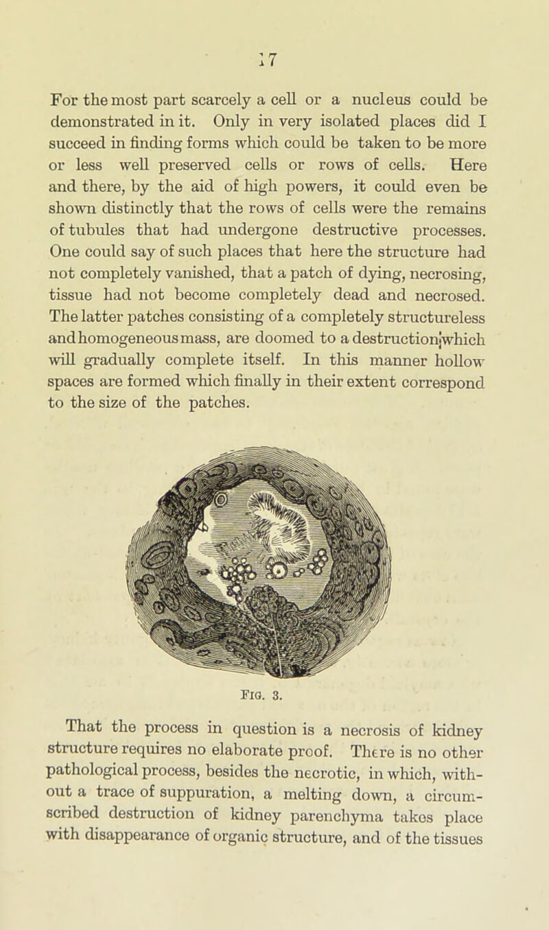 For the most part scarcely a cell or a nucleus could be demonstrated in it. Only in very isolated places did I succeed in finding forms which could be taken to be more or less well preserved cells or rows of cells. Here and there, by the aid of high powers, it could even be shown distinctly that the rows of cells were the remains of tubules that had undergone destructive processes. One could say of such places that here the structure had not completely vanished, that a patch of dying, necrosing, tissue had not become completely dead and necrosed. The latter patches consisting of a completely structureless and homogeneous mass, are doomed to a destructionjwhich will gradually complete itself. In this manner hollow spaces are formed winch finally in their extent correspond to the size of the patches. Fig. 3. That the process in question is a necrosis of kidney structure requires no elaborate proof. There is no other pathological process, besides the necrotic, in which, with- out a trace of suppuration, a melting down, a circum- scribed destruction of kidney parenchyma takes place with disappearance of organic structure, and of the tissues