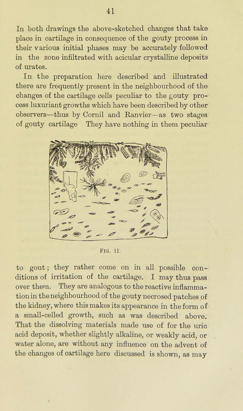 In both drawings the above-sketched changes that take place in cartilage in consequence of the gouty process in their various initial phases may be accurately followed in the zone infiltrated with acicular crystalline deposits of urates. In the preparation here described and illustrated there are frequently present in the neighbourhood of the changes of the cartilage cells peculiar to the gouty pro- cess luxuriant growths which have been described by other observers—thus by Cornil and Ranvier—as two stages of gouty cartilage They have nothing in them peculiar Fig. u. to gout; they rather come on in all possible con- ditions of irritation of the cartilage. I may thus pass over them. They are analogous to the reactive inflamma- tion in the neighbourhood of the gouty necrosed patches of the kidney, where this makes its appearance in the form of a small-celled growth, such as was described above. That the dissolving materials made use of for the uric acid deposit, whether slightly alkaline, or weakly acid, or water alone, are without any influence on the advent of the changes of cartilage here discussed is shown, as may