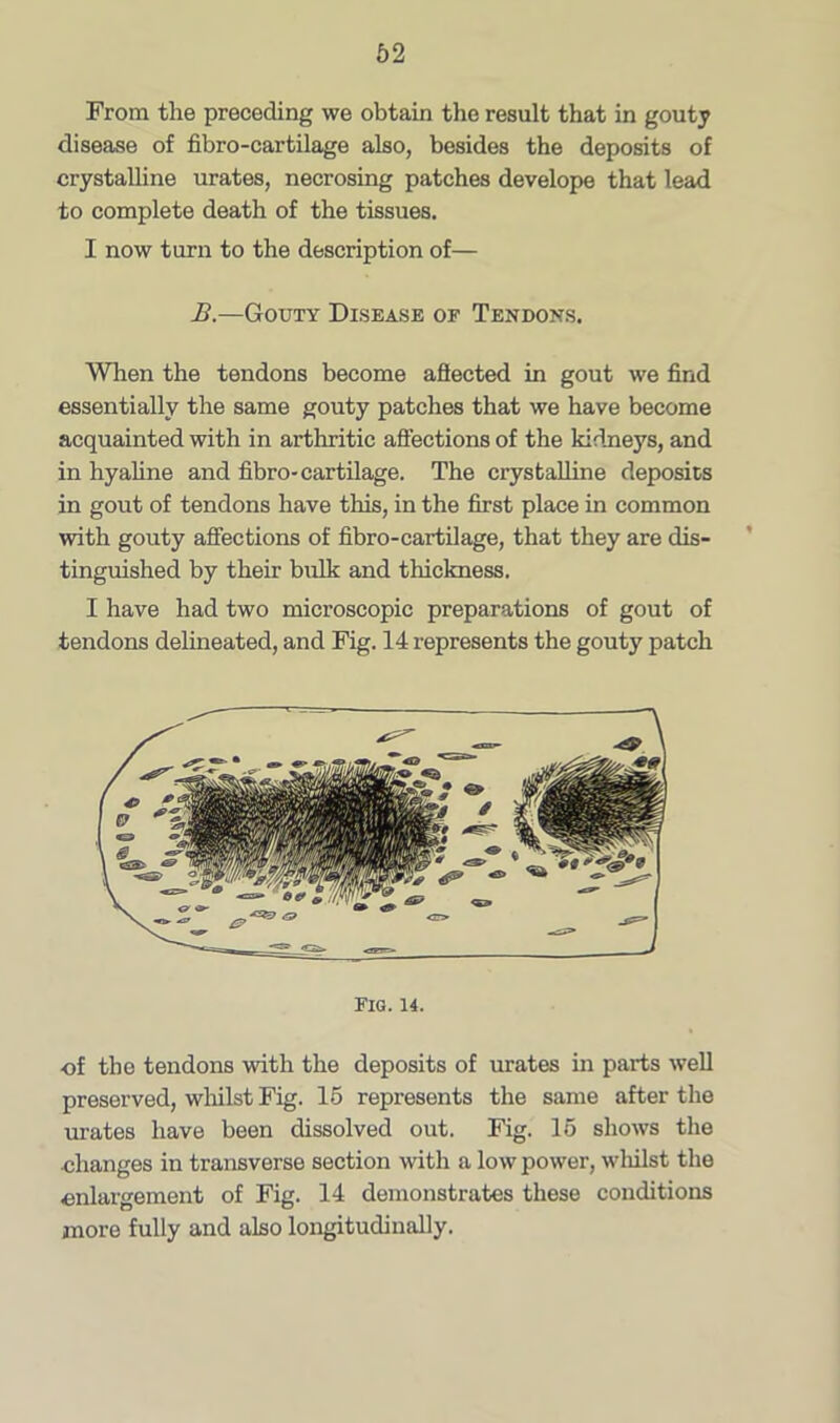 From the preceding we obtain the result that in gouty disease of fibro-cartilage also, besides the deposits of crystalline urates, necrosing patches develope that lead to complete death of the tissues. I now turn to the description of— B.—Gouty Disease of Tendons. When the tendons become aflected in gout we find essentially the same gouty patches that we have become acquainted with in arthritic affections of the kidneys, and in hyaline and fibro-cartilage. The crystalline deposits in gout of tendons have this, in the first place in common with gouty affections of fibro-cartilage, that they are dis- tinguished by their bulk and thickness. I have had two microscopic preparations of gout of tendons delineated, and Fig. 14 represents the gouty patch Fig. 14. of the tendons with the deposits of urates in parts well preserved, whilst Fig. 15 represents the same after the urates have been dissolved out. Fig. 15 shows the changes in transverse section with a low power, whilst the enlargement of Fig. 14 demonstrates these conditions more fully and also longitudinally.