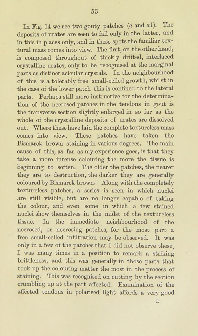 In Fig. 14 we see two gouty patches (a and a\). The deposits of urates are seen to fail only in the latter, and in this in places only, and in these spots the familiar tex- tural mass comes into view. The first, on the other hand, is composed throughout of thickly drifted, interlaced crystalline urates, only to be recognised at the marginal parts as distinct acicular crystals. In the neighbourhood -of this is a tolerably free small-celled growth, whilst in the case of the lower patch this is confined to the lateral parts. Perhaps still more instructive for the determina- tion of the necrosed patches in the tendons in gout is the transverse section slightly enlarged in so far as the whole of the crystalline deposits of urates are dissolved out. Where these have lain the complete textureless mass comes into view. These patches have taken the Bismarck brown staining in various degrees. The main cause of this, as far as my experience goes, is that they take a more intense colouring the more the tissue is beginning to soften. The older the patches, the nearer they are to destruction, the darker they are generally coloured by Bismarck brown. Along with the completely textureless patches, a series is seen in which nuclei are still visible, but are no longer capable of taking the colour, and even some in which a few stained nuclei show themselves in the midst of the textureless tissue. In the immediate neighbourhood of the necrosed, or necrosing patches, for the most part a free small-celled infiltration may be observed. It was only in a few of the patches that I did not observe these, I was many times in a position to remark a striking brittleness, and this was generally in those parts that took up the colouring matter the most in the process of staining. This was recognised on cutting by the section crumbling up at the part affected. Examination of the affected tendons in polarised fight affords a very good E