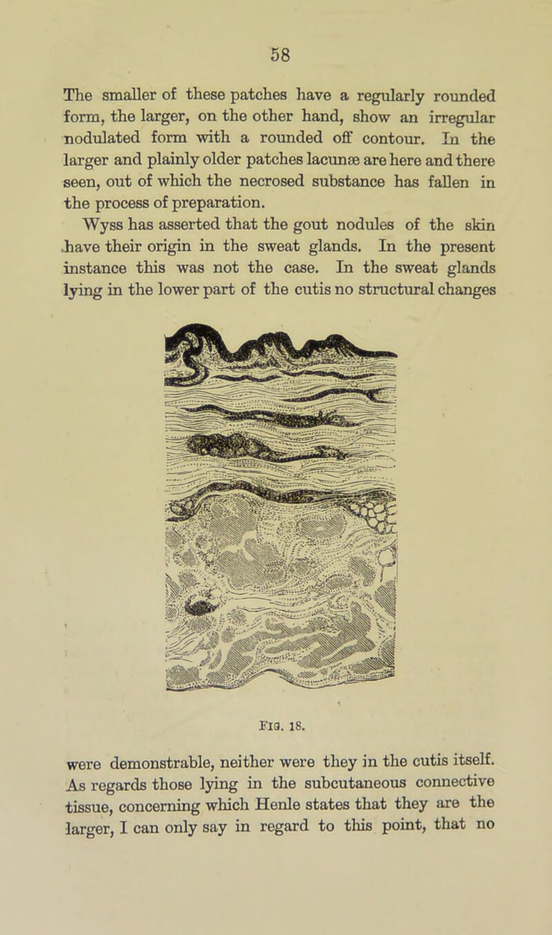 The smaller of these patches have a regularly rounded form, the larger, on the other hand, show an irregular nodulated form with a rounded off contour. In the larger and plainly older patches lacunae are here and there seen, out of which the necrosed substance has fallen in the process of preparation. Wyss has asserted that the gout nodules of the skin .have their origin in the sweat glands. In the present instance this was not the case. In the sweat glands lying in the lower part of the cutis no structural changes Fia. is. were demonstrable, neither were they in the cutis itself. As regards those lying in the subcutaneous connective tissue, concerning which Henle states that they are the larger, I can only say in regard to this point, that no