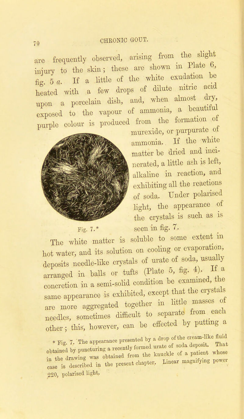 are frequently observed, arising from tbe slig iiiiury to tlie skin; these are shown in Plate b, fig. 5 a. If a little of the white exudation be heated mth a few drops of dilute nitric acid upon a porcelain dish, and, when almost dr> exposed to the vapour of ammonia, a beautiful purple colour is produced from_ the formation of murexide, or purpurate or ammonia. If the white matter be dried and inci- nerated, a little ash is left, alkaline in reaction, and exhibiting all the reactions of soda. Under polarised light, the appearance of the crystals is such as is seen in fig. 7. The white matter is soluble to some extent in hot water, and its solution on cooling or evaporation, deposits needle-Hke crystals of urate of soda, usua y arranged in halls or tufts (Plate 6, fig. 4). If a concretion in a semi-soUd condition be exammsd, the same appearance is exliibited, except that the ciysta s are more aggregated together in litt e masses o needles, sometimes difficult to separate from each other; this, however, can be effected y pu mg a obtXea I, pu.01™ .S » “ ““ ‘‘T ; s ! ops! is desoribed i. lie prssent ctopter. Ime.r P— 220, polarised light. Fig. 7.*