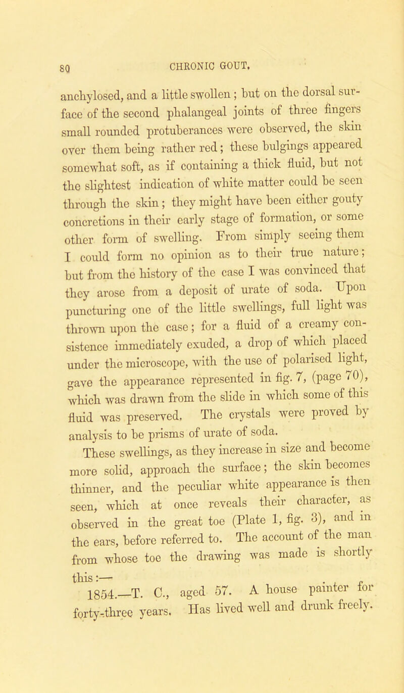 8Q anchylosed, and a little swollen ; but on tlie dorsal sur- face of the second phalangeal joints of three fingers sruall rounded protuberances were observed, the skin over them being rather red; these bulgings appeared somewhat soft, as if containing a thick fluid, but not the shghtest indication of white matter could be seen through the skin; they might have been either gouty concretions in their early stage of formation, or some other form of swelHng. From simply seeing them I could form no opinion as to their true nature; but from the history of the case I was convinced that they arose from a deposit of urate of soda. TJpon punctm-ing one of the little swellings, full light was thrown upon the case; for a fluid of a creamy con- sistence immediately exuded, a drop of which placed under the microscope, with the use of polarised light, gave the appearance represented in fig. 7, (page 70), which was drawn from the slide in which some of this fluid was preserved, The crystals were proved b} analysis to be prisms of urate of soda. These swellings, as they increase in size and become more sohd, approach the surface; the skin becomes thinner, and the pecuHar white appearance is then seen, which at once reveals their character, as observed in the great toe (Plate 1, fig- 3), and in the ears, before referred to. The account of the man from whose toe the drawing was made is shortly this:— . 1854.—T. C., aged 57. A house painter lor forty-.three years. Has lived well and drunk freely.